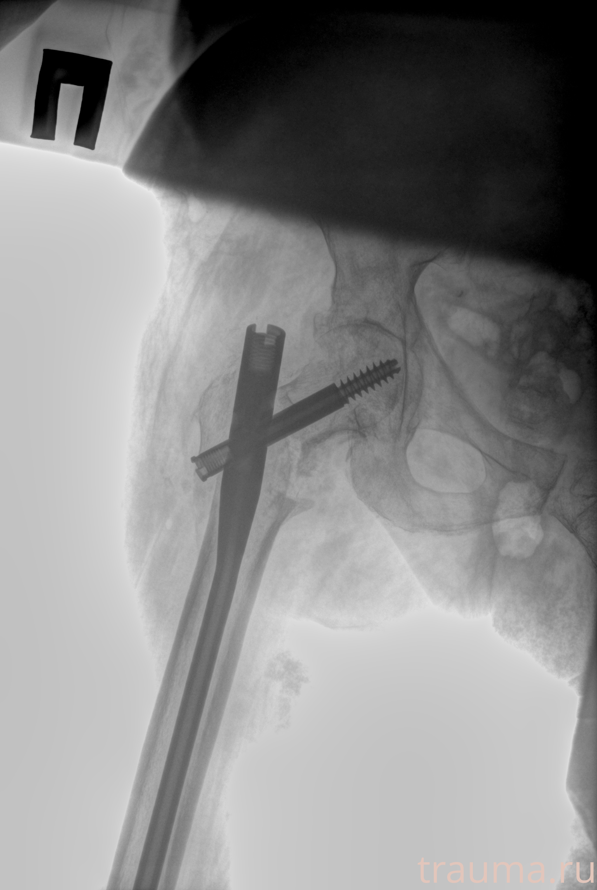 Рентген на дому: по вашему адресу приезжает врач-рентгенолог, травматолог-ортопед с мобильным рентгеновским аппаратом, проводит диагностику травмы или заболевания, делает необходимые рентгенограммы, дает рекомендации по дальнейшему лечению. Получить качественные снимки в домашних условиях возможно благодаря уникальной методике, разработанной МосРентген Центром для института  Склифосовского