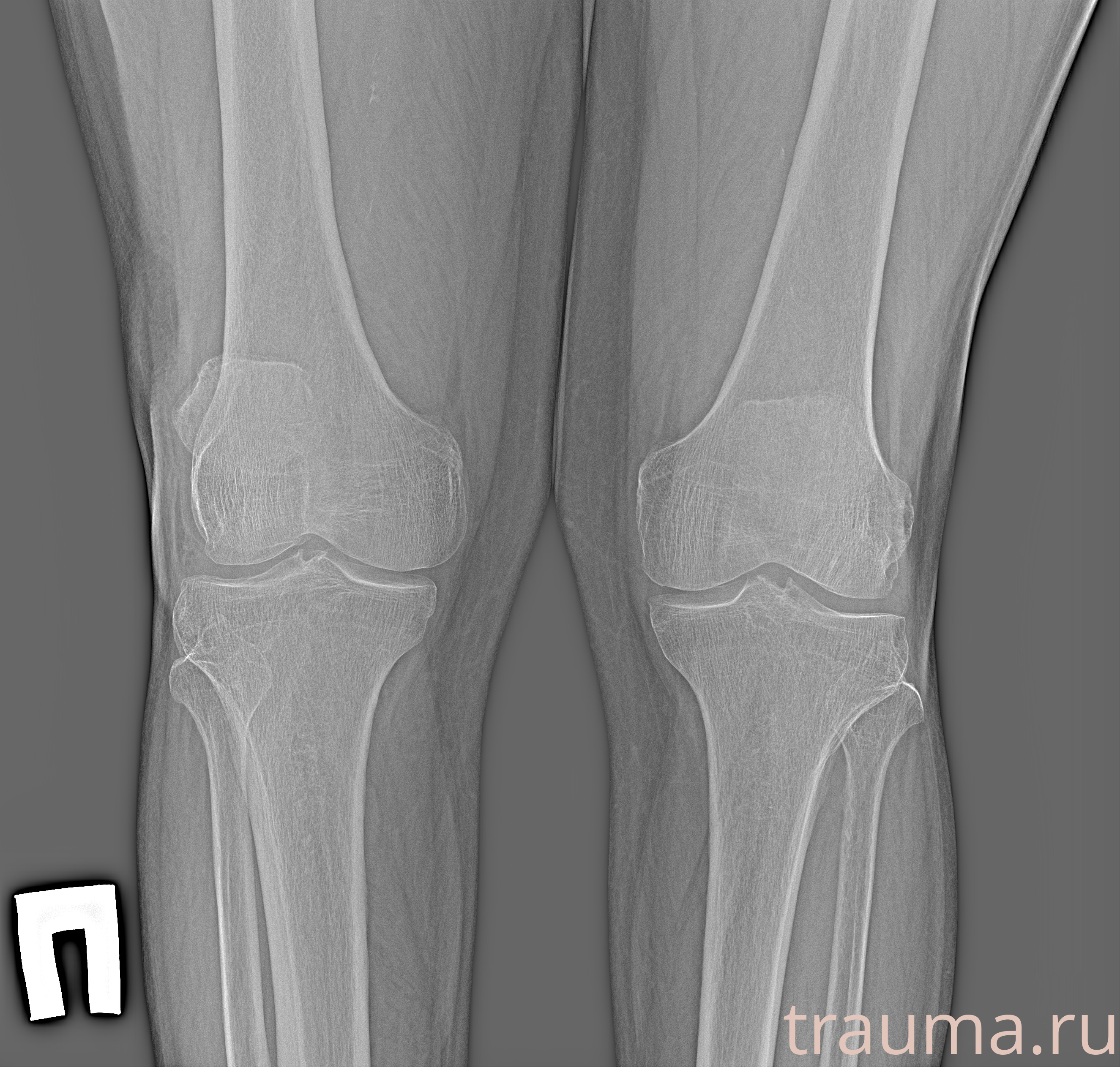 Рентген на дому: по вашему адресу приезжает врач-рентгенолог, травматолог-ортопед с мобильным рентгеновским аппаратом, проводит диагностику травмы или заболевания, делает необходимые рентгенограммы, дает рекомендации по дальнейшему лечению. Получить качественные снимки в домашних условиях возможно благодаря уникальной методике, разработанной МосРентген Центром для института  Склифосовского