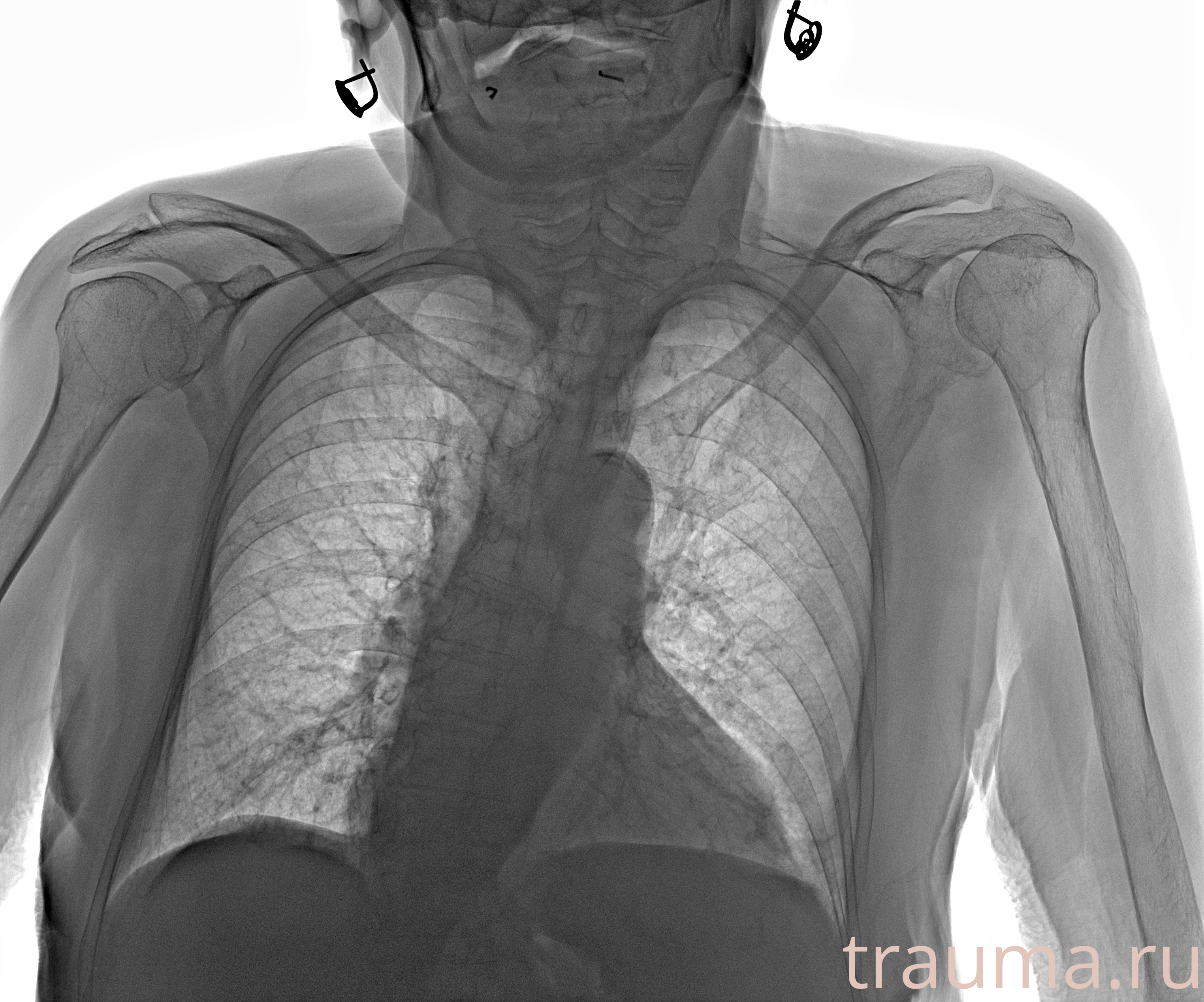 Рентген на дому: по вашему адресу приезжает врач-рентгенолог, травматолог-ортопед с мобильным рентгеновским аппаратом, проводит диагностику травмы или заболевания, делает необходимые рентгенограммы, дает рекомендации по дальнейшему лечению. Получить качественные снимки в домашних условиях возможно благодаря уникальной методике, разработанной МосРентген Центром для института  Склифосовского