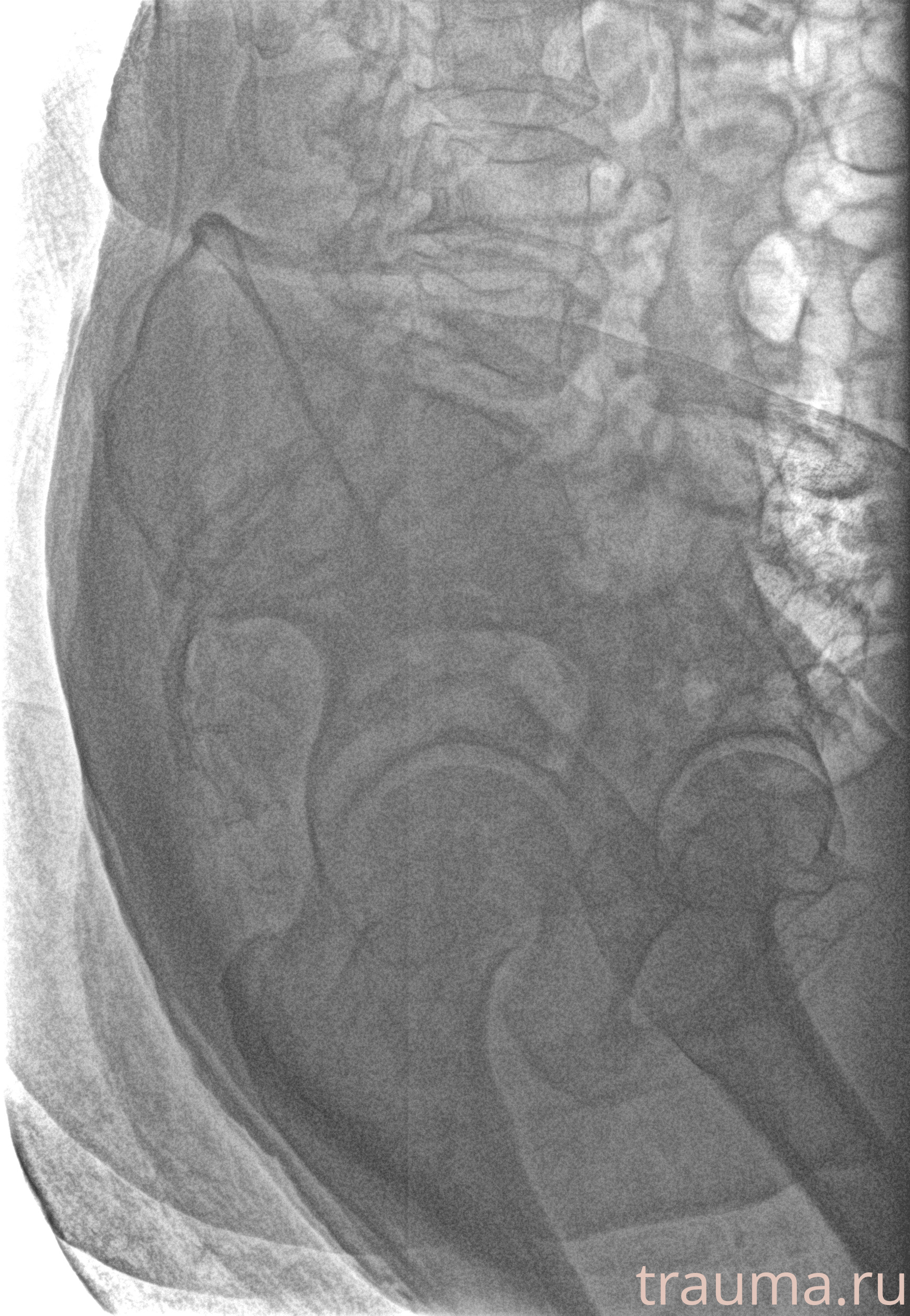 Рентген на дому: по вашему адресу приезжает врач-рентгенолог, травматолог-ортопед с мобильным рентгеновским аппаратом, проводит диагностику травмы или заболевания, делает необходимые рентгенограммы, дает рекомендации по дальнейшему лечению. Получить качественные снимки в домашних условиях возможно благодаря уникальной методике, разработанной МосРентген Центром для института  Склифосовского