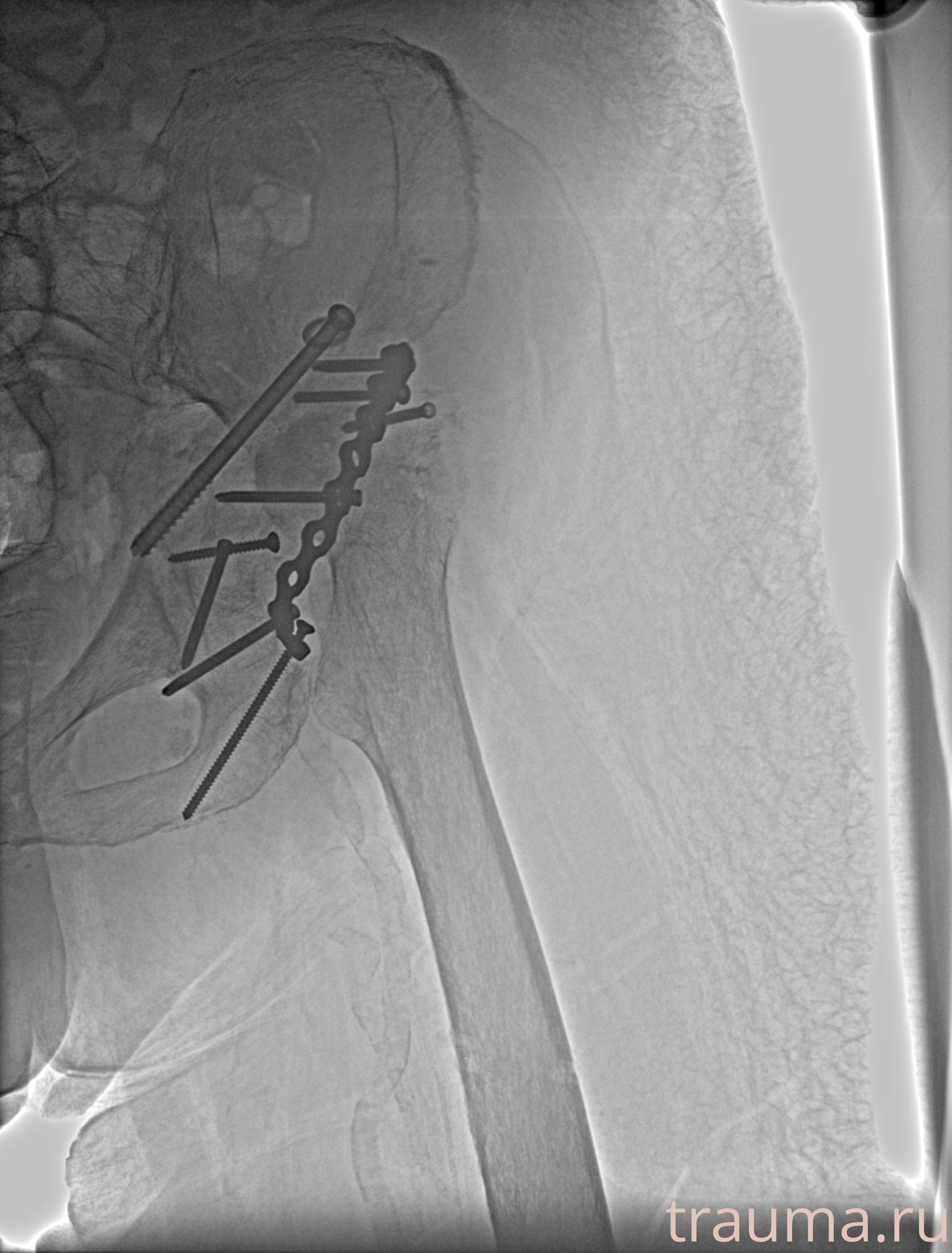 Рентген на дому: по вашему адресу приезжает врач-рентгенолог, травматолог-ортопед с мобильным рентгеновским аппаратом, проводит диагностику травмы или заболевания, делает необходимые рентгенограммы, дает рекомендации по дальнейшему лечению. Получить качественные снимки в домашних условиях возможно благодаря уникальной методике, разработанной МосРентген Центром для института  Склифосовского