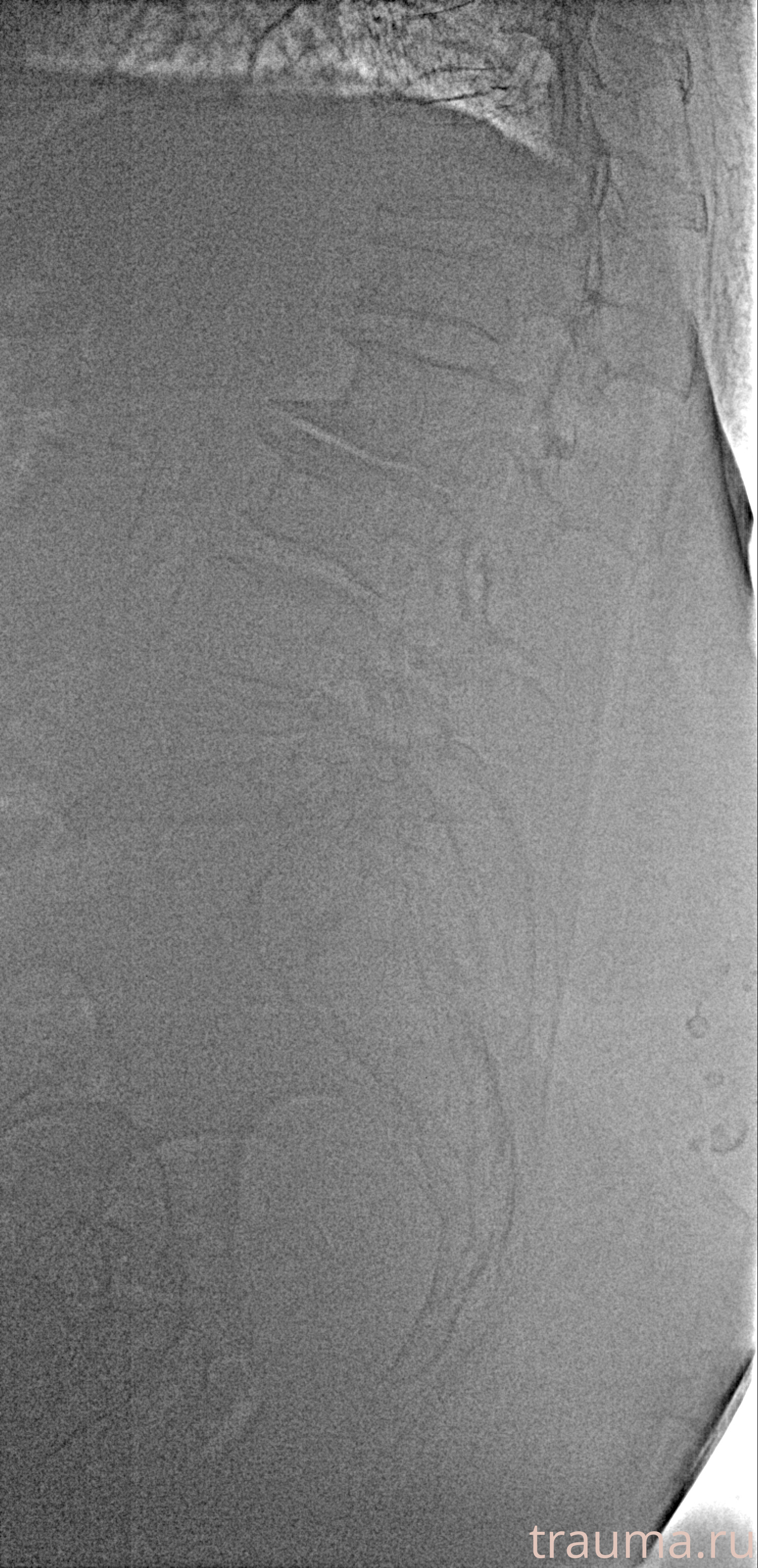 Рентген на дому: по вашему адресу приезжает врач-рентгенолог, травматолог-ортопед с мобильным рентгеновским аппаратом, проводит диагностику травмы или заболевания, делает необходимые рентгенограммы, дает рекомендации по дальнейшему лечению. Получить качественные снимки в домашних условиях возможно благодаря уникальной методике, разработанной МосРентген Центром для института  Склифосовского