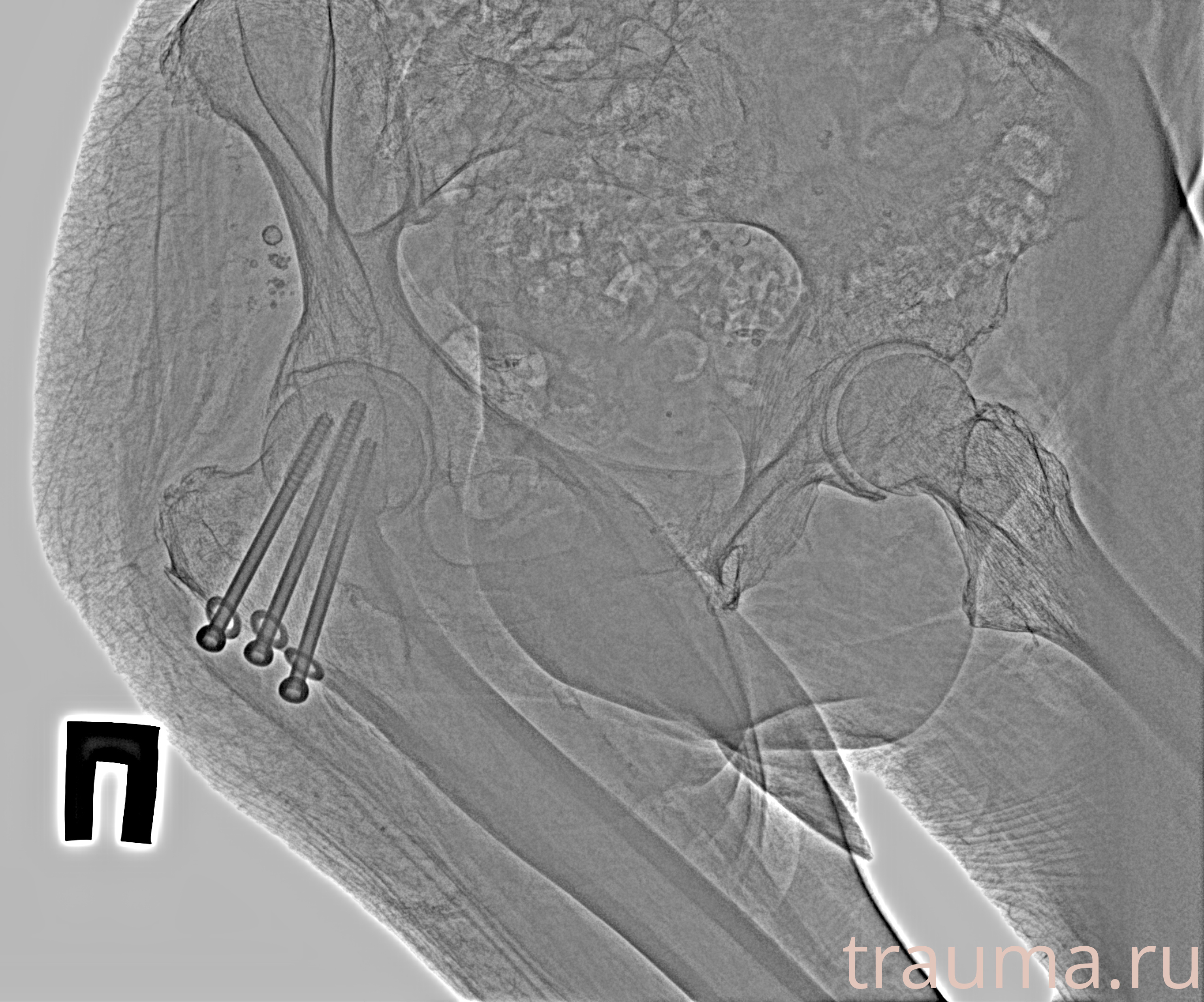 Рентген на дому: по вашему адресу приезжает врач-рентгенолог, травматолог-ортопед с мобильным рентгеновским аппаратом, проводит диагностику травмы или заболевания, делает необходимые рентгенограммы, дает рекомендации по дальнейшему лечению. Получить качественные снимки в домашних условиях возможно благодаря уникальной методике, разработанной МосРентген Центром для института  Склифосовского