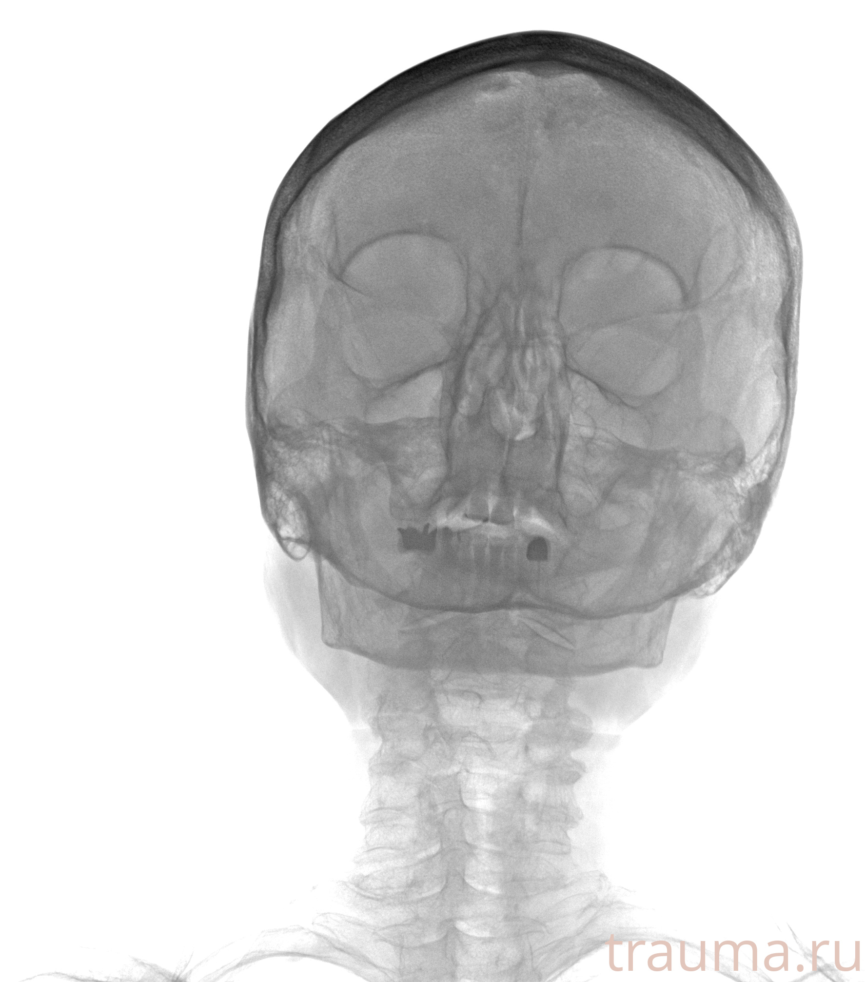 Рентген на дому: по вашему адресу приезжает врач-рентгенолог, травматолог-ортопед с мобильным рентгеновским аппаратом, проводит диагностику травмы или заболевания, делает необходимые рентгенограммы, дает рекомендации по дальнейшему лечению. Получить качественные снимки в домашних условиях возможно благодаря уникальной методике, разработанной МосРентген Центром для института  Склифосовского