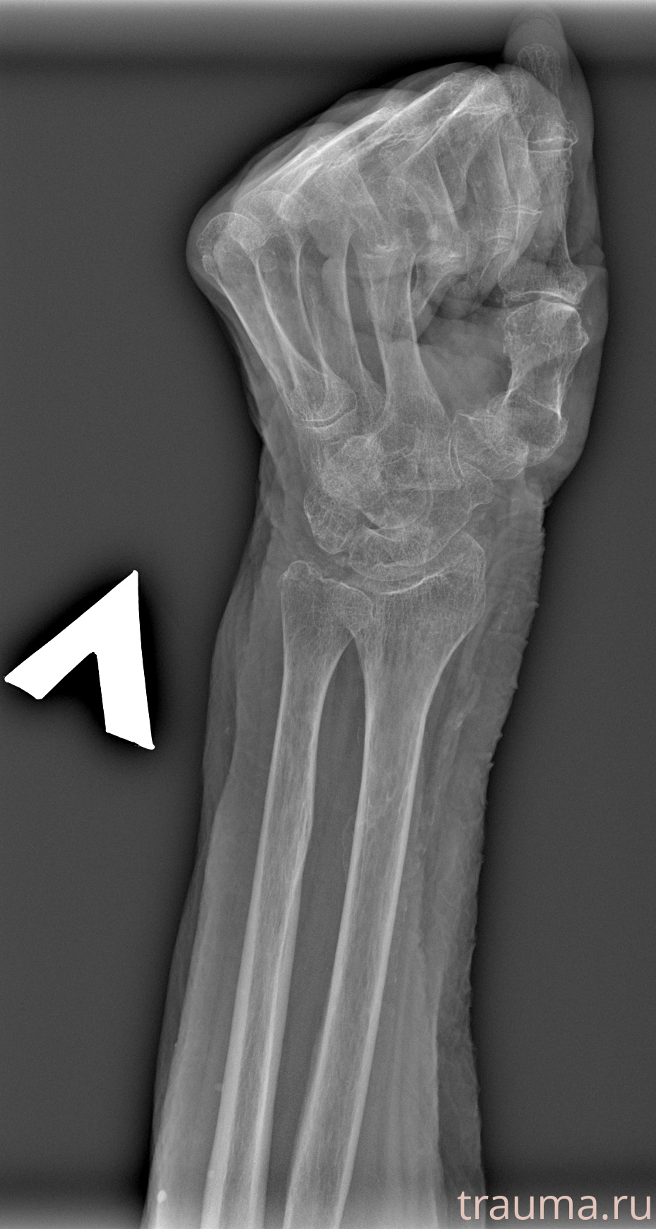 Рентген на дому: по вашему адресу приезжает врач-рентгенолог, травматолог-ортопед с мобильным рентгеновским аппаратом, проводит диагностику травмы или заболевания, делает необходимые рентгенограммы, дает рекомендации по дальнейшему лечению. Получить качественные снимки в домашних условиях возможно благодаря уникальной методике, разработанной МосРентген Центром для института  Склифосовского