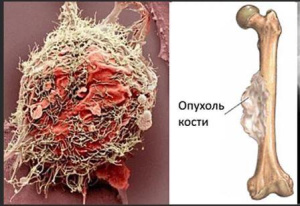 Курс медицинской рентгенологии. Рентгенодиагностика. Опухоли костей. Часть 2. Глава 6 Курс медицинской рентгенологии. Рентгенодиагностика. Опухоли костей. Часть 2. Глава 6