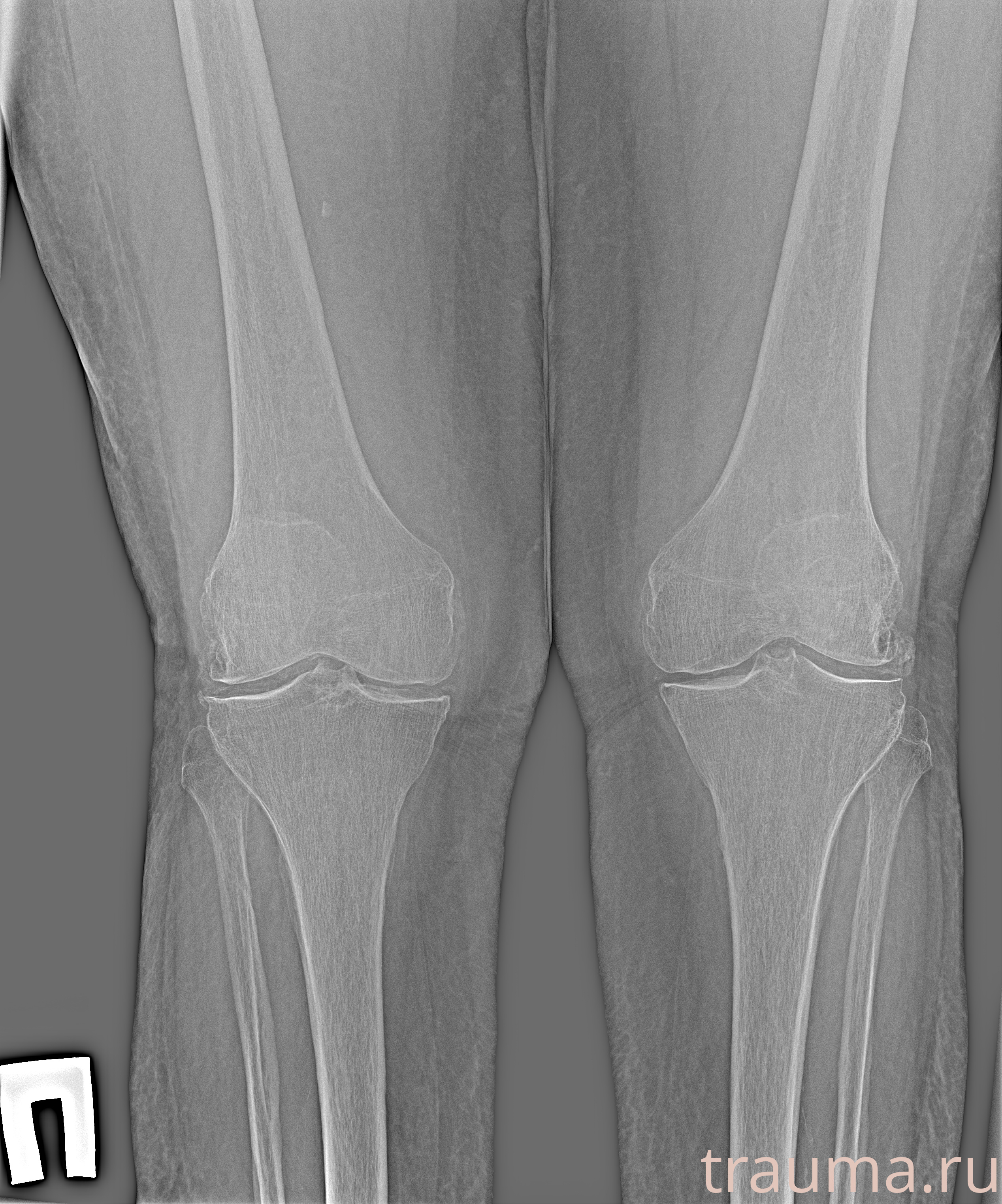 Рентген на дому: по вашему адресу приезжает врач-рентгенолог, травматолог-ортопед с мобильным рентгеновским аппаратом, проводит диагностику травмы или заболевания, делает необходимые рентгенограммы, дает рекомендации по дальнейшему лечению. Получить качественные снимки в домашних условиях возможно благодаря уникальной методике, разработанной МосРентген Центром для института  Склифосовского
