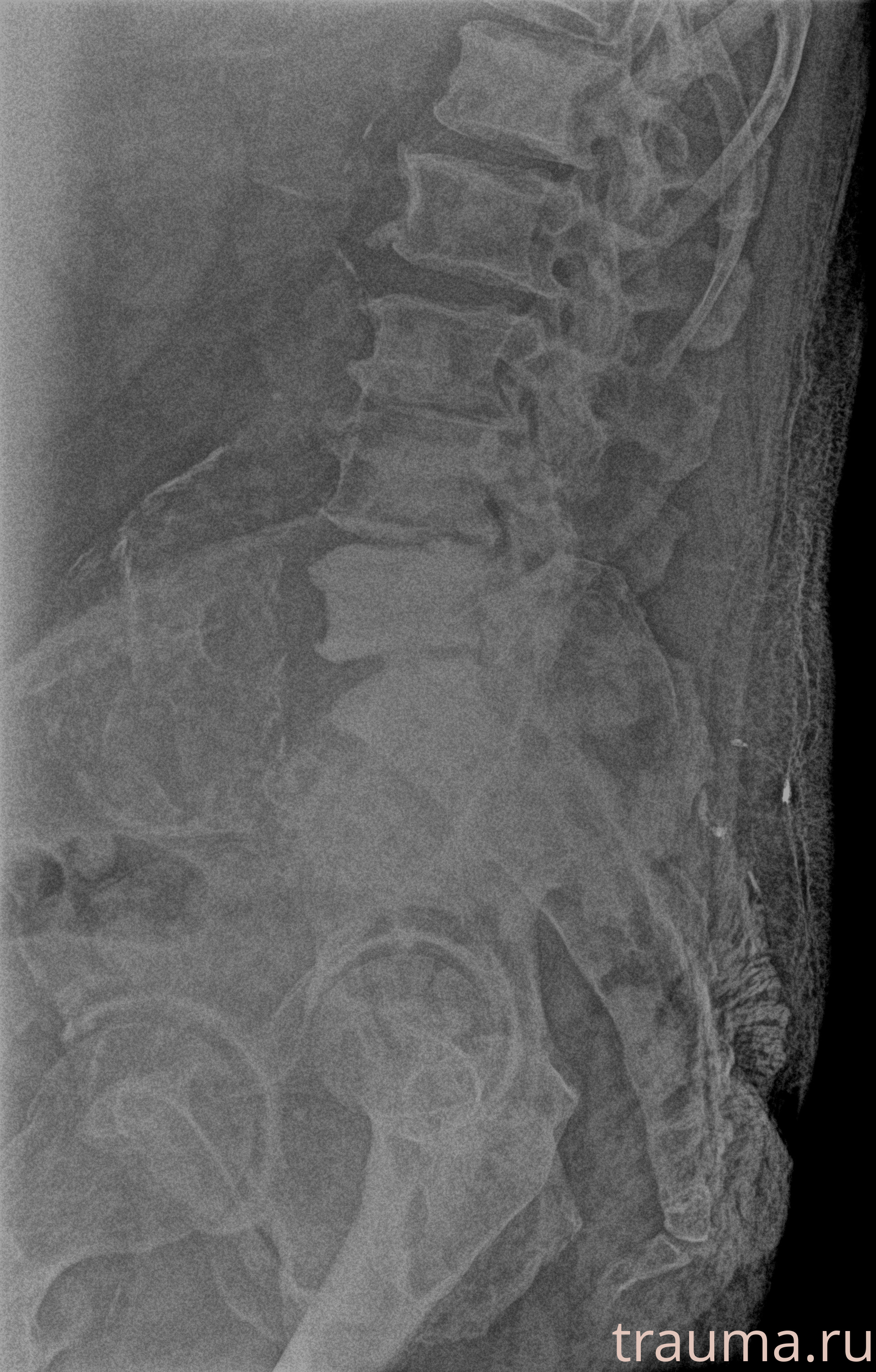 Рентген на дому: по вашему адресу приезжает врач-рентгенолог, травматолог-ортопед с мобильным рентгеновским аппаратом, проводит диагностику травмы или заболевания, делает необходимые рентгенограммы, дает рекомендации по дальнейшему лечению. Получить качественные снимки в домашних условиях возможно благодаря уникальной методике, разработанной МосРентген Центром для института  Склифосовского