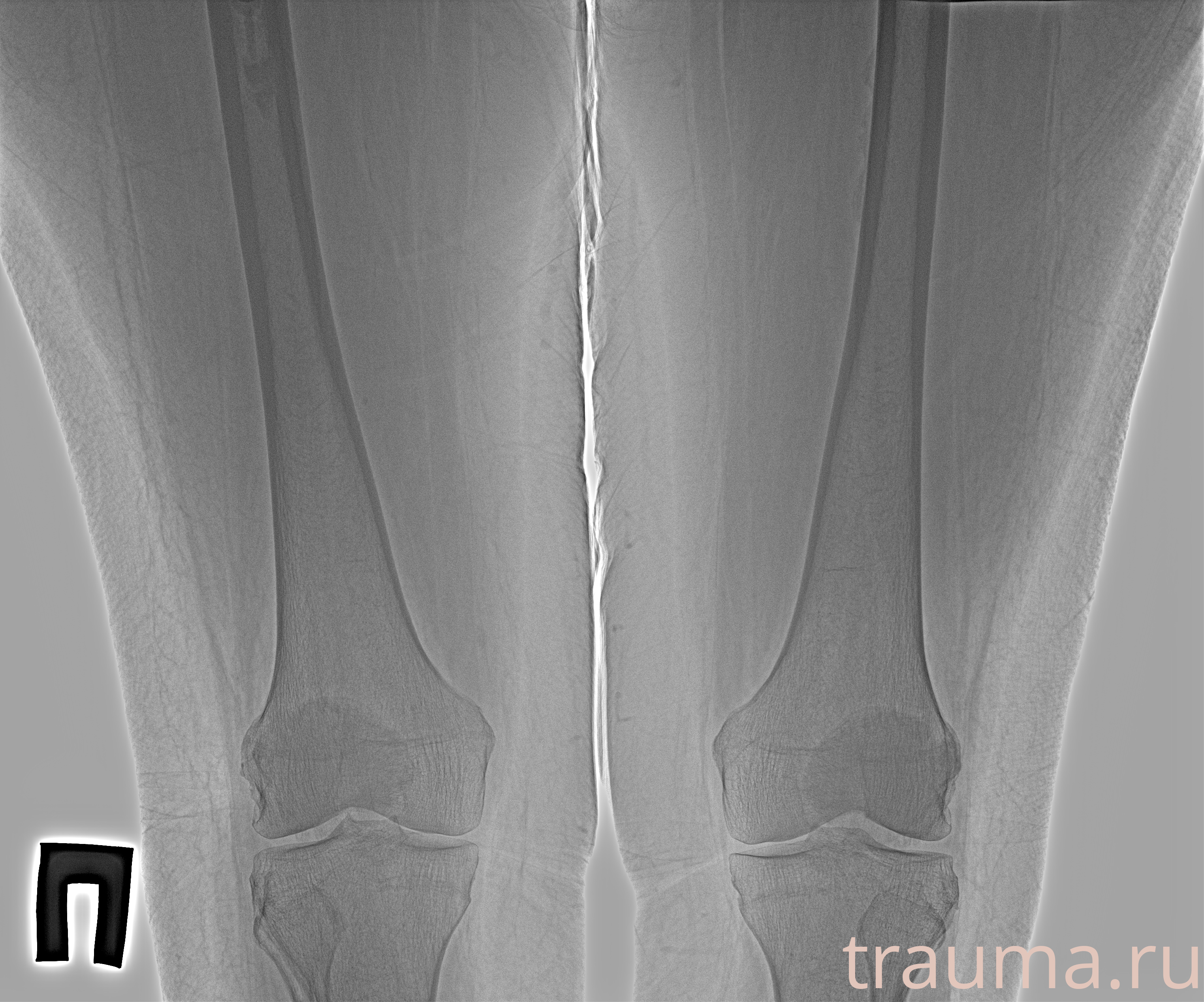 Рентген на дому: по вашему адресу приезжает врач-рентгенолог, травматолог-ортопед с мобильным рентгеновским аппаратом, проводит диагностику травмы или заболевания, делает необходимые рентгенограммы, дает рекомендации по дальнейшему лечению. Получить качественные снимки в домашних условиях возможно благодаря уникальной методике, разработанной МосРентген Центром для института  Склифосовского