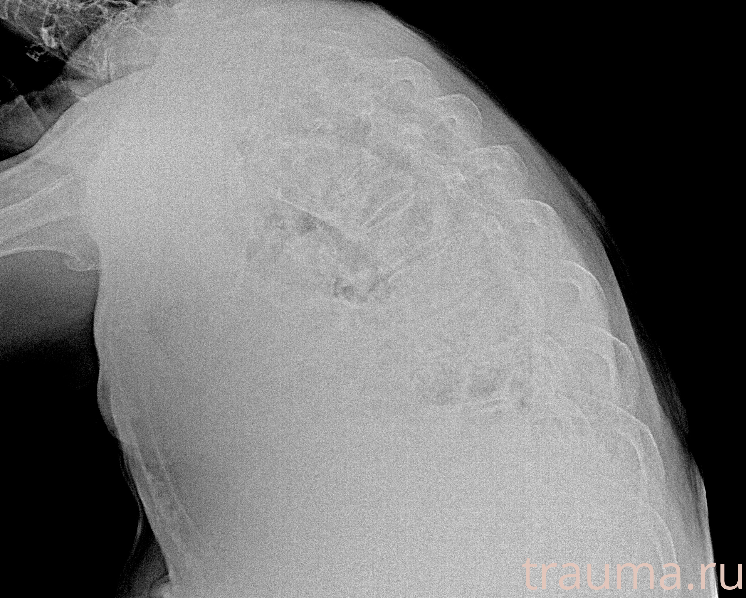 Рентген на дому: по вашему адресу приезжает врач-рентгенолог, травматолог-ортопед с мобильным рентгеновским аппаратом, проводит диагностику травмы или заболевания, делает необходимые рентгенограммы, дает рекомендации по дальнейшему лечению. Получить качественные снимки в домашних условиях возможно благодаря уникальной методике, разработанной МосРентген Центром для института  Склифосовского