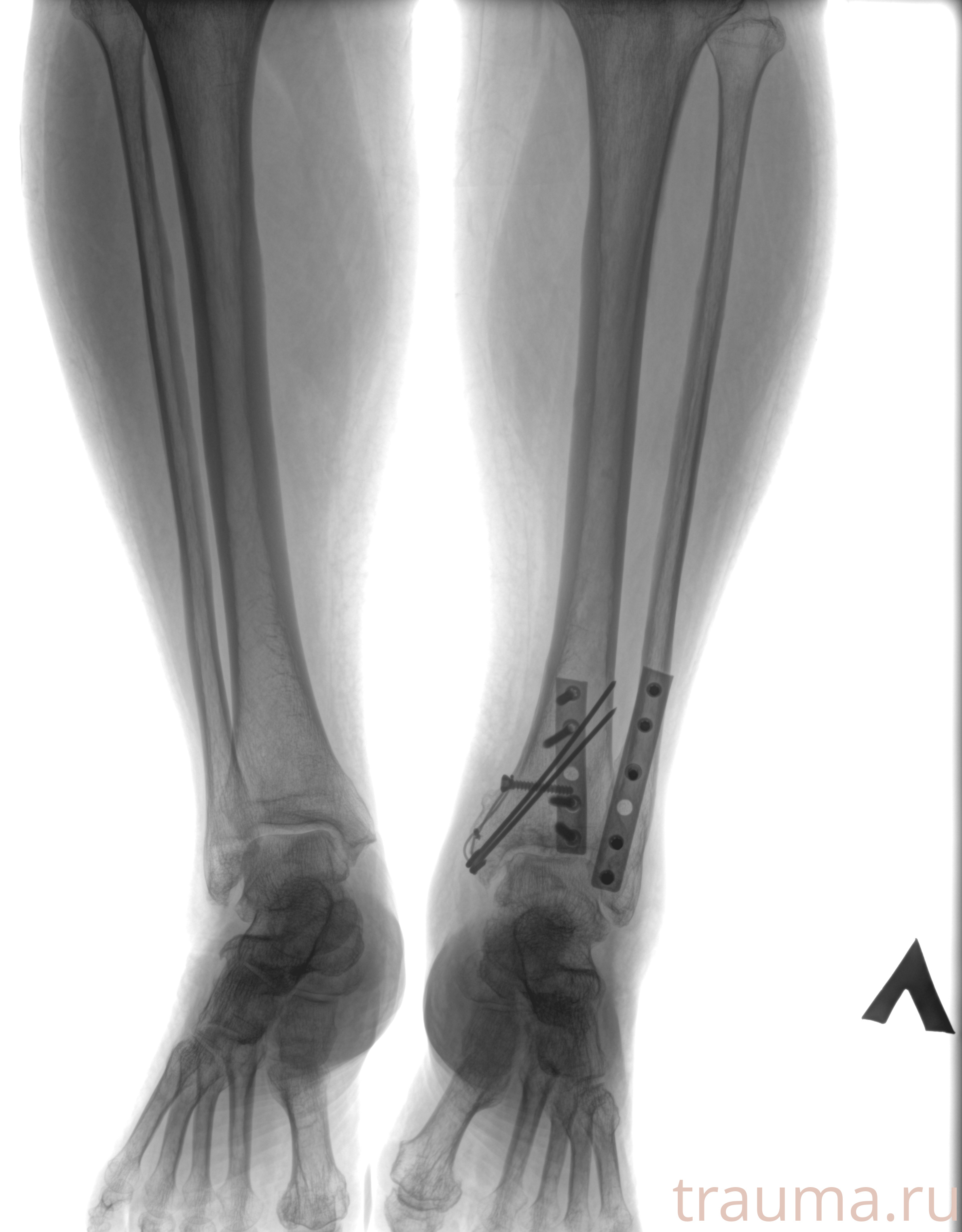 Рентген на дому: по вашему адресу приезжает врач-рентгенолог, травматолог-ортопед с мобильным рентгеновским аппаратом, проводит диагностику травмы или заболевания, делает необходимые рентгенограммы, дает рекомендации по дальнейшему лечению. Получить качественные снимки в домашних условиях возможно благодаря уникальной методике, разработанной МосРентген Центром для института  Склифосовского