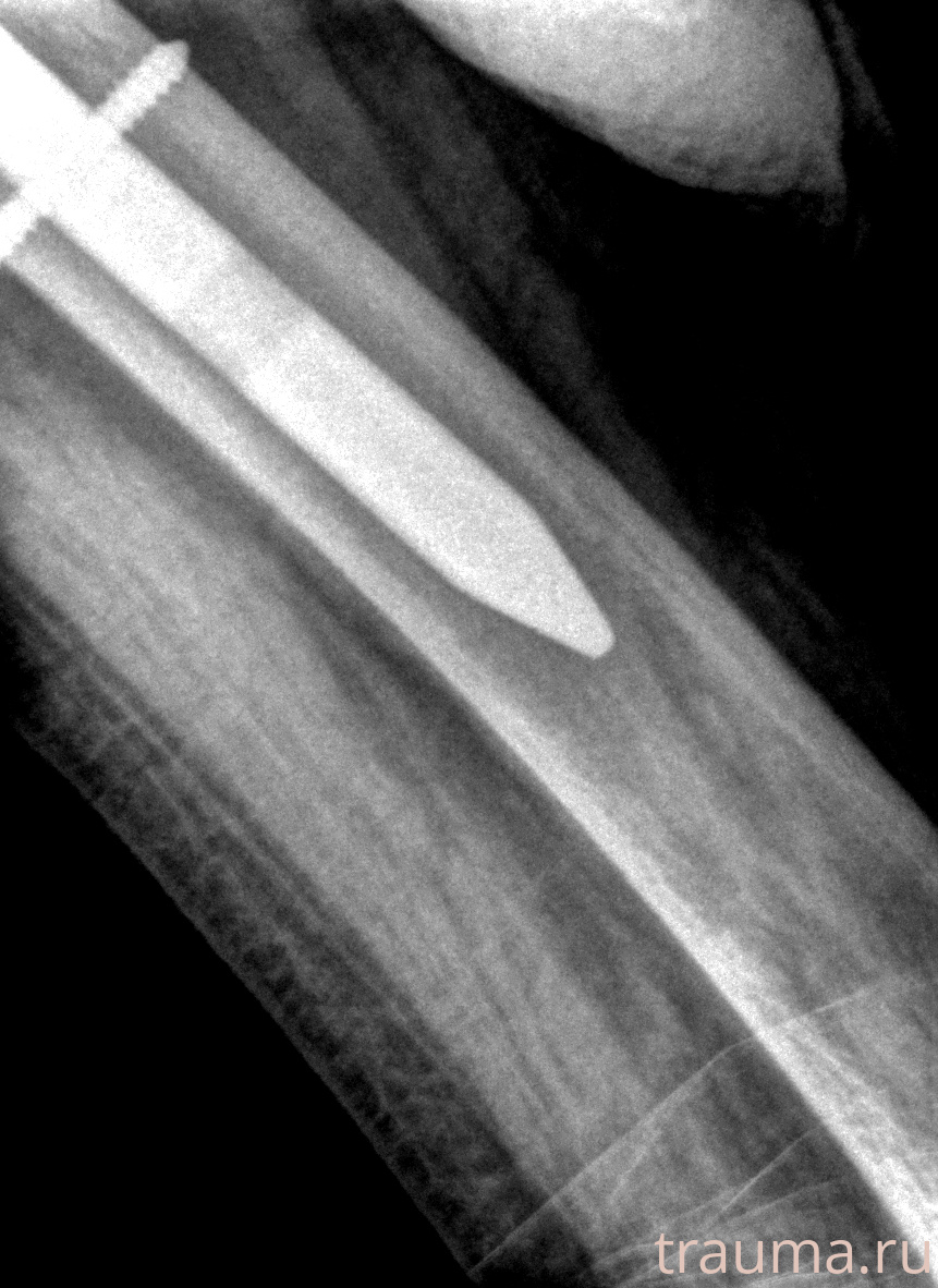 Рентген на дому: по вашему адресу приезжает врач-рентгенолог, травматолог-ортопед с мобильным рентгеновским аппаратом, проводит диагностику травмы или заболевания, делает необходимые рентгенограммы, дает рекомендации по дальнейшему лечению. Получить качественные снимки в домашних условиях возможно благодаря уникальной методике, разработанной МосРентген Центром для института  Склифосовского