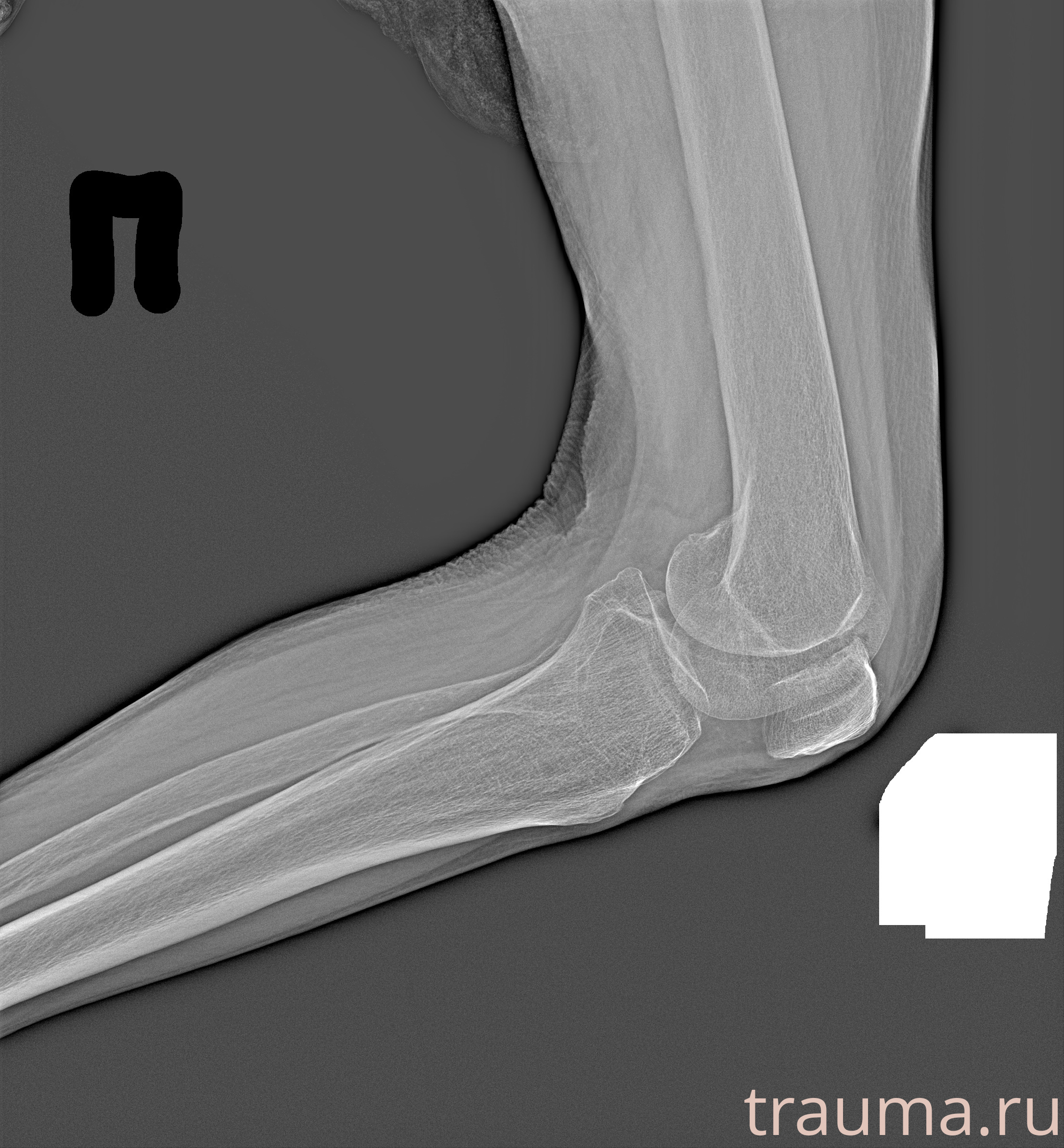 Рентген на дому: по вашему адресу приезжает врач-рентгенолог, травматолог-ортопед с мобильным рентгеновским аппаратом, проводит диагностику травмы или заболевания, делает необходимые рентгенограммы, дает рекомендации по дальнейшему лечению. Получить качественные снимки в домашних условиях возможно благодаря уникальной методике, разработанной МосРентген Центром для института  Склифосовского