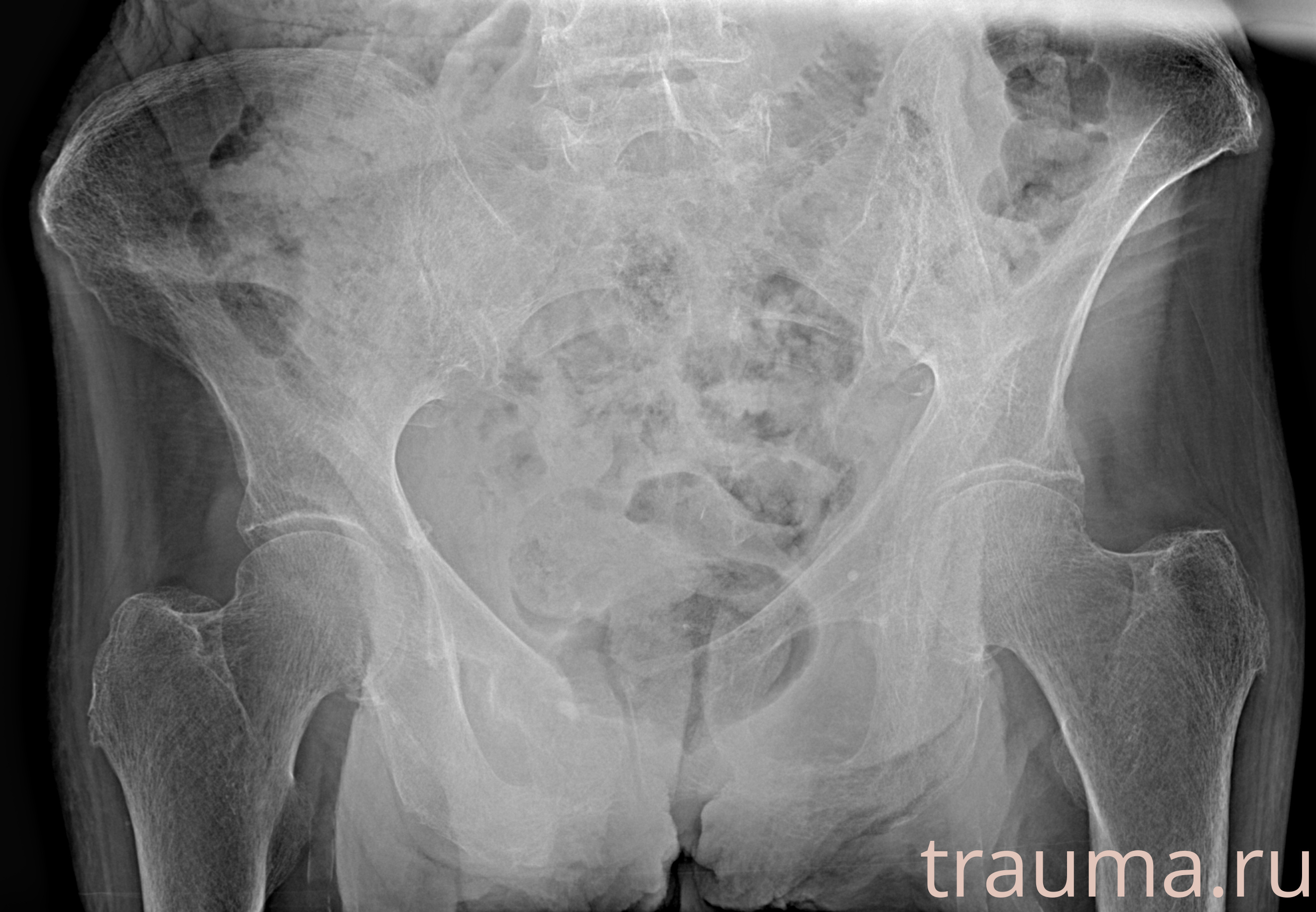 Рентген на дому: по вашему адресу приезжает врач-рентгенолог, травматолог-ортопед с мобильным рентгеновским аппаратом, проводит диагностику травмы или заболевания, делает необходимые рентгенограммы, дает рекомендации по дальнейшему лечению. Получить качественные снимки в домашних условиях возможно благодаря уникальной методике, разработанной МосРентген Центром для института  Склифосовского