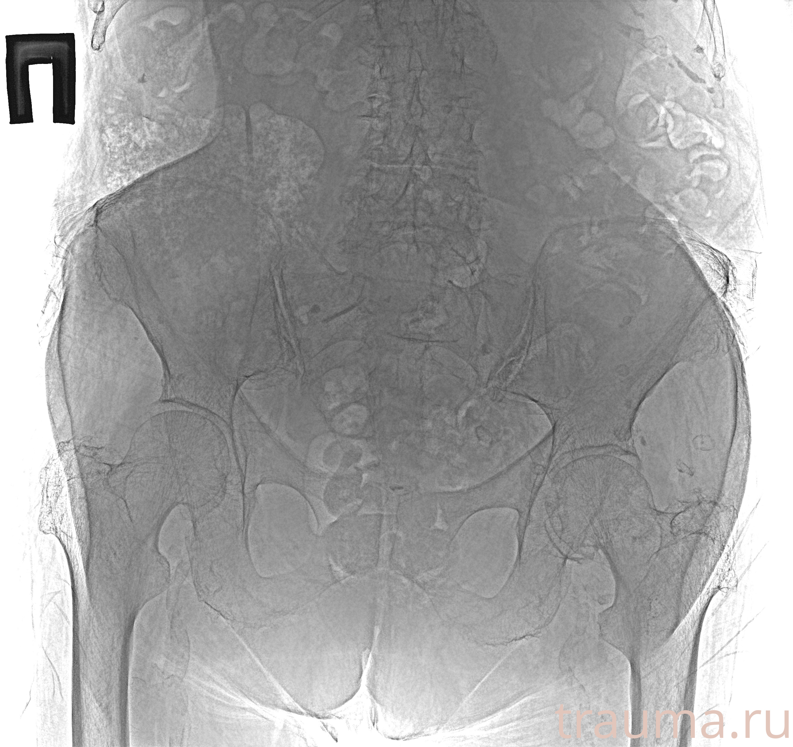 Рентген на дому: по вашему адресу приезжает врач-рентгенолог, травматолог-ортопед с мобильным рентгеновским аппаратом, проводит диагностику травмы или заболевания, делает необходимые рентгенограммы, дает рекомендации по дальнейшему лечению. Получить качественные снимки в домашних условиях возможно благодаря уникальной методике, разработанной МосРентген Центром для института  Склифосовского