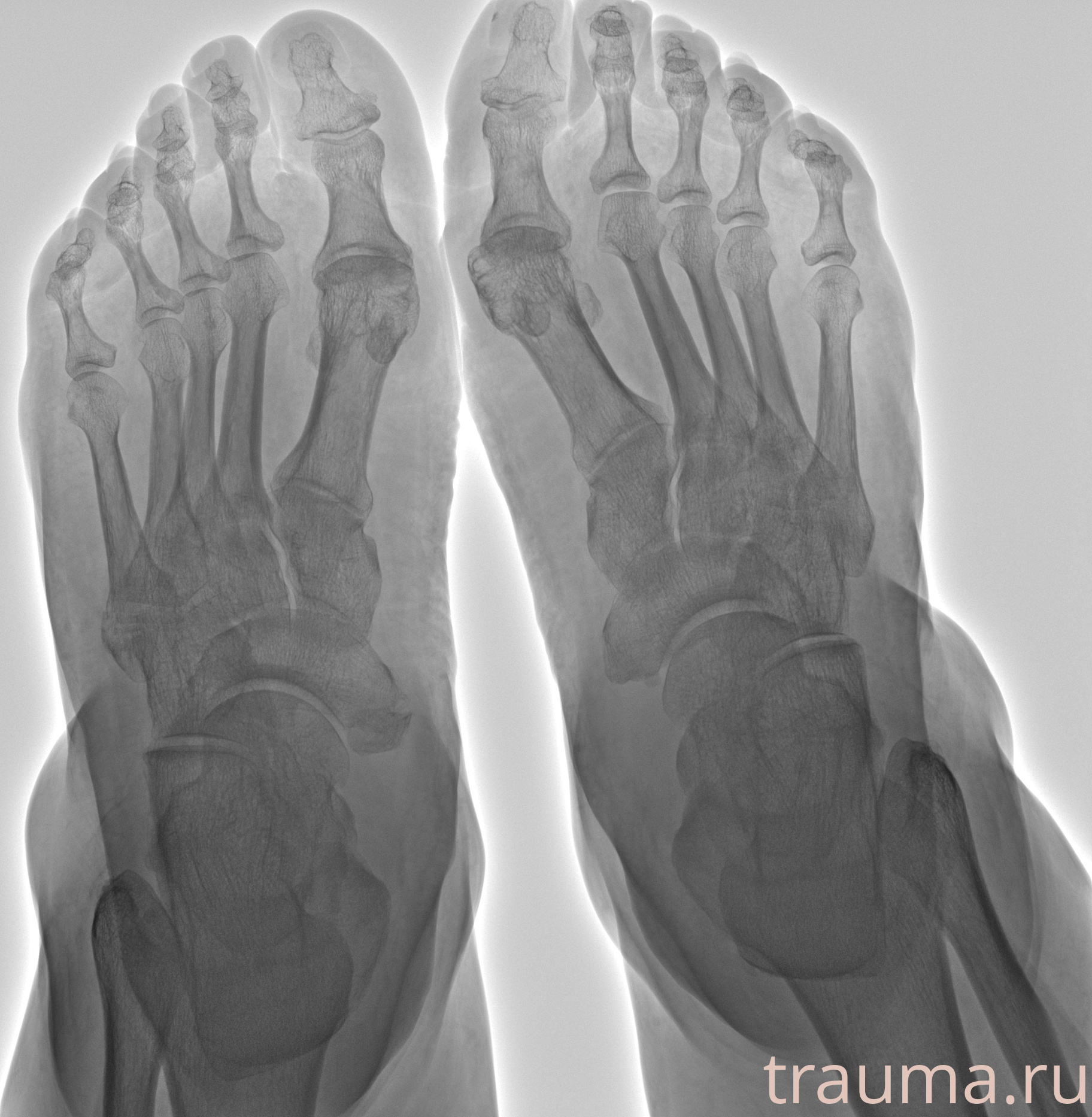 Рентген на дому: по вашему адресу приезжает врач-рентгенолог, травматолог-ортопед с мобильным рентгеновским аппаратом, проводит диагностику травмы или заболевания, делает необходимые рентгенограммы, дает рекомендации по дальнейшему лечению. Получить качественные снимки в домашних условиях возможно благодаря уникальной методике, разработанной МосРентген Центром для института  Склифосовского