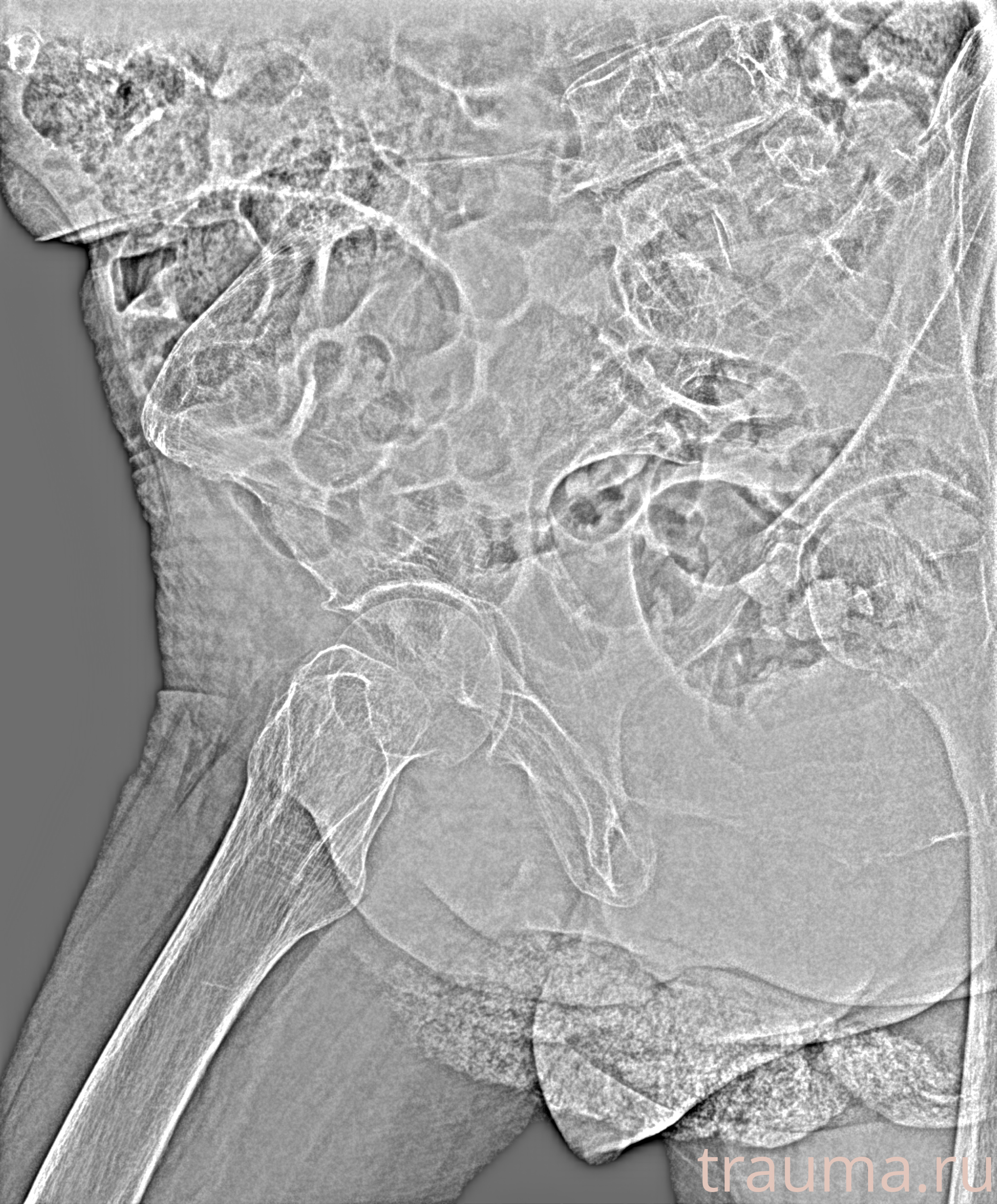 Рентген на дому: по вашему адресу приезжает врач-рентгенолог, травматолог-ортопед с мобильным рентгеновским аппаратом, проводит диагностику травмы или заболевания, делает необходимые рентгенограммы, дает рекомендации по дальнейшему лечению. Получить качественные снимки в домашних условиях возможно благодаря уникальной методике, разработанной МосРентген Центром для института  Склифосовского