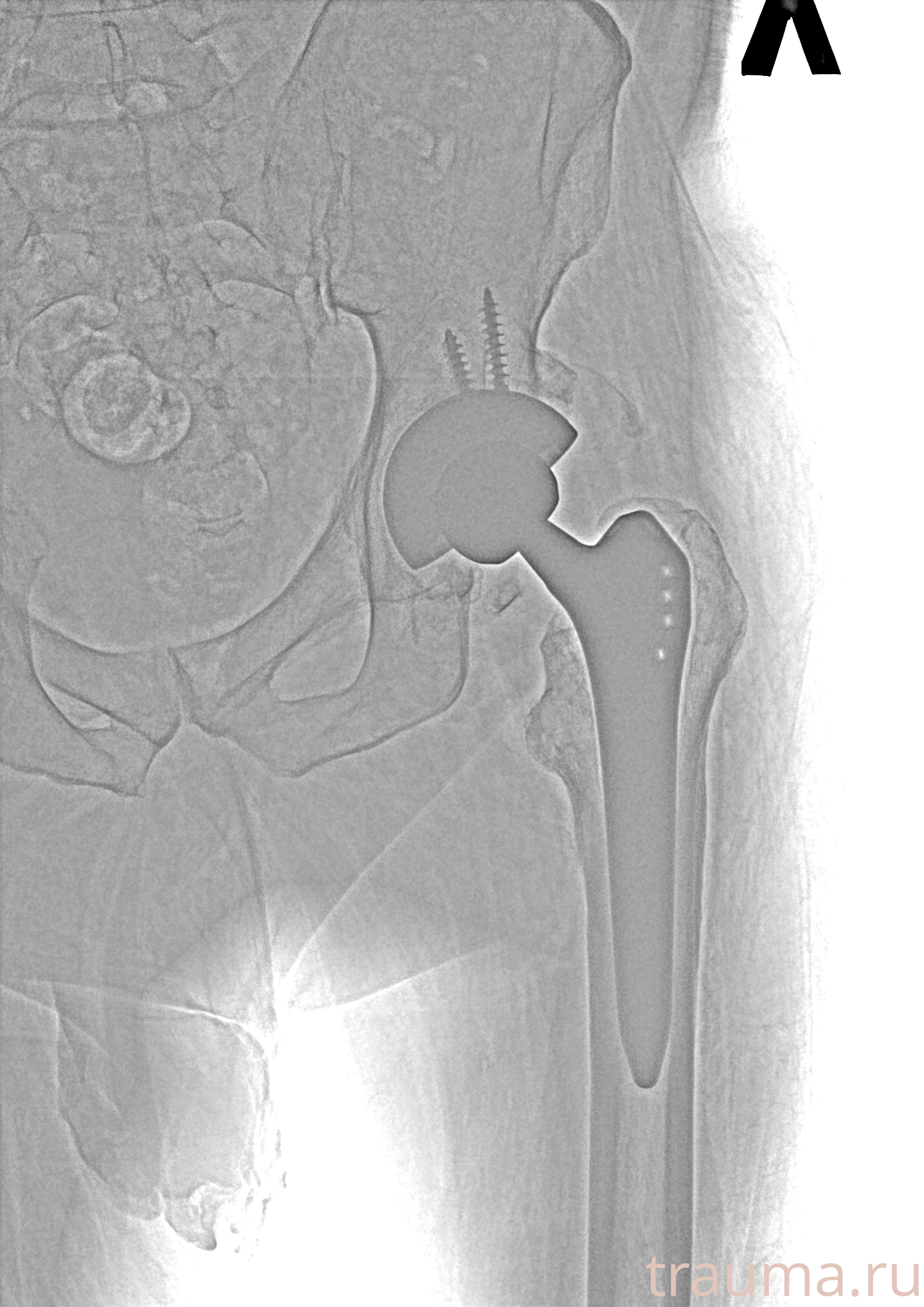 Рентген на дому: по вашему адресу приезжает врач-рентгенолог, травматолог-ортопед с мобильным рентгеновским аппаратом, проводит диагностику травмы или заболевания, делает необходимые рентгенограммы, дает рекомендации по дальнейшему лечению. Получить качественные снимки в домашних условиях возможно благодаря уникальной методике, разработанной МосРентген Центром для института  Склифосовского