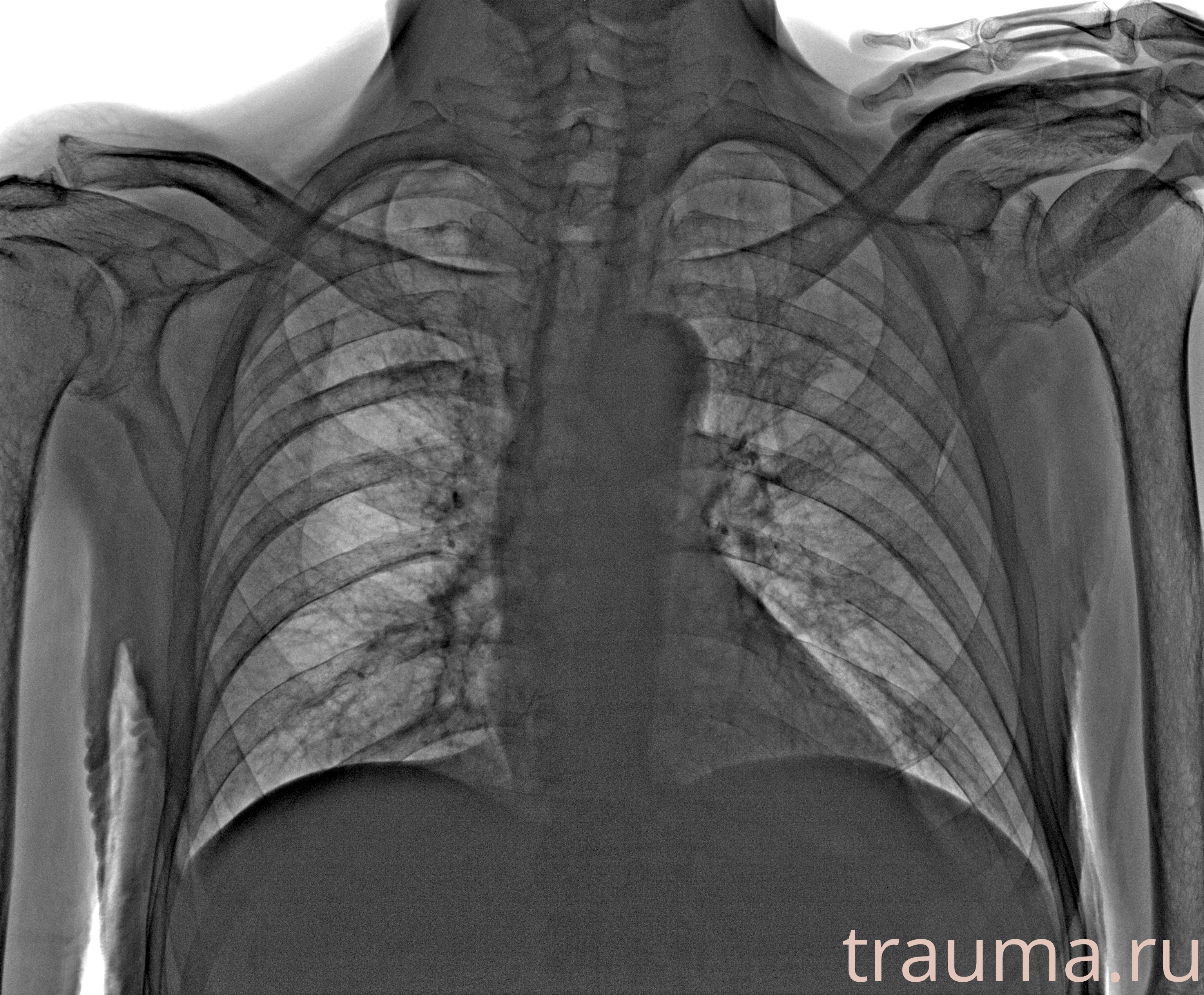 Рентген на дому: по вашему адресу приезжает врач-рентгенолог, травматолог-ортопед с мобильным рентгеновским аппаратом, проводит диагностику травмы или заболевания, делает необходимые рентгенограммы, дает рекомендации по дальнейшему лечению. Получить качественные снимки в домашних условиях возможно благодаря уникальной методике, разработанной МосРентген Центром для института  Склифосовского