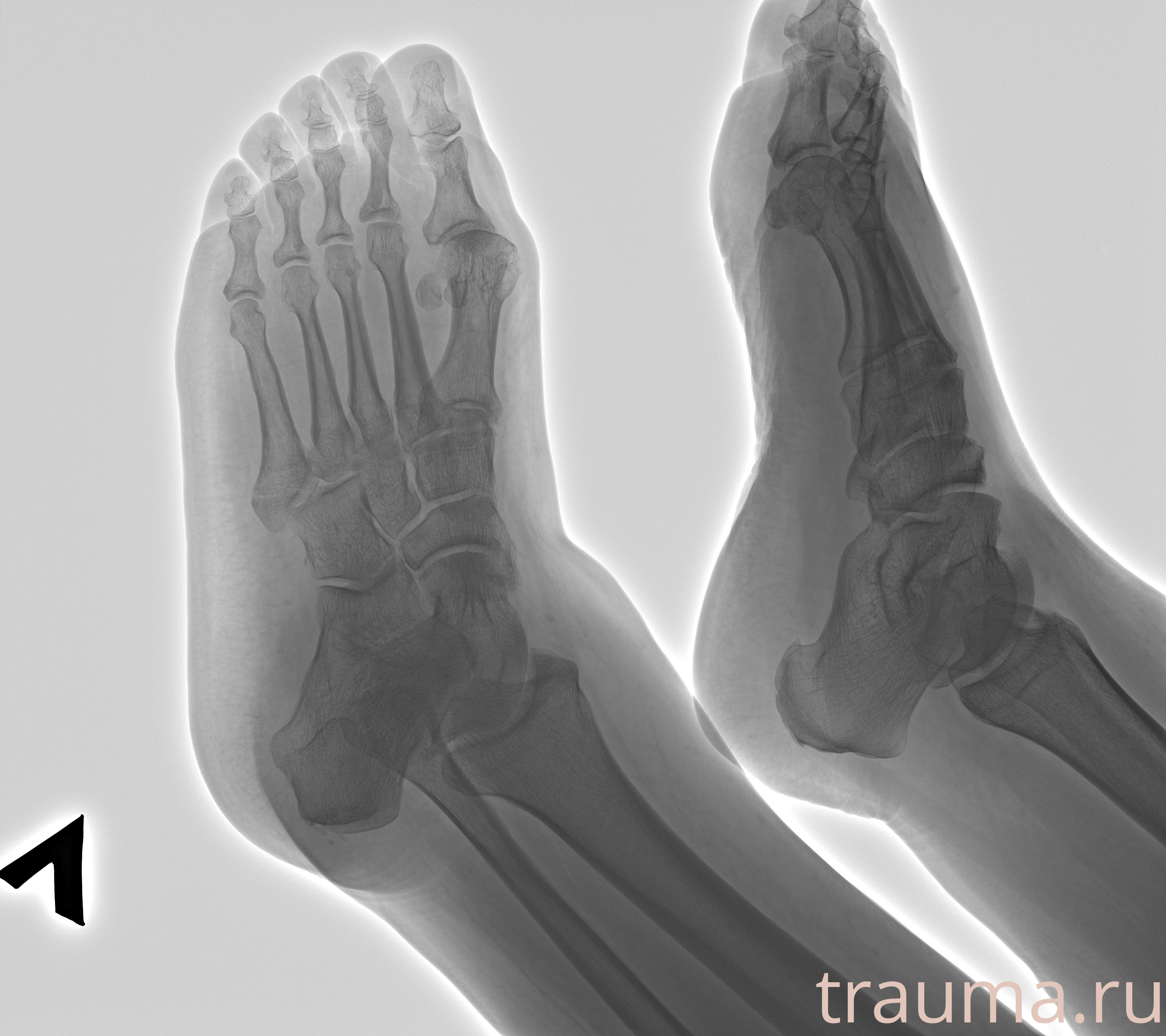 Рентген на дому: по вашему адресу приезжает врач-рентгенолог, травматолог-ортопед с мобильным рентгеновским аппаратом, проводит диагностику травмы или заболевания, делает необходимые рентгенограммы, дает рекомендации по дальнейшему лечению. Получить качественные снимки в домашних условиях возможно благодаря уникальной методике, разработанной МосРентген Центром для института  Склифосовского