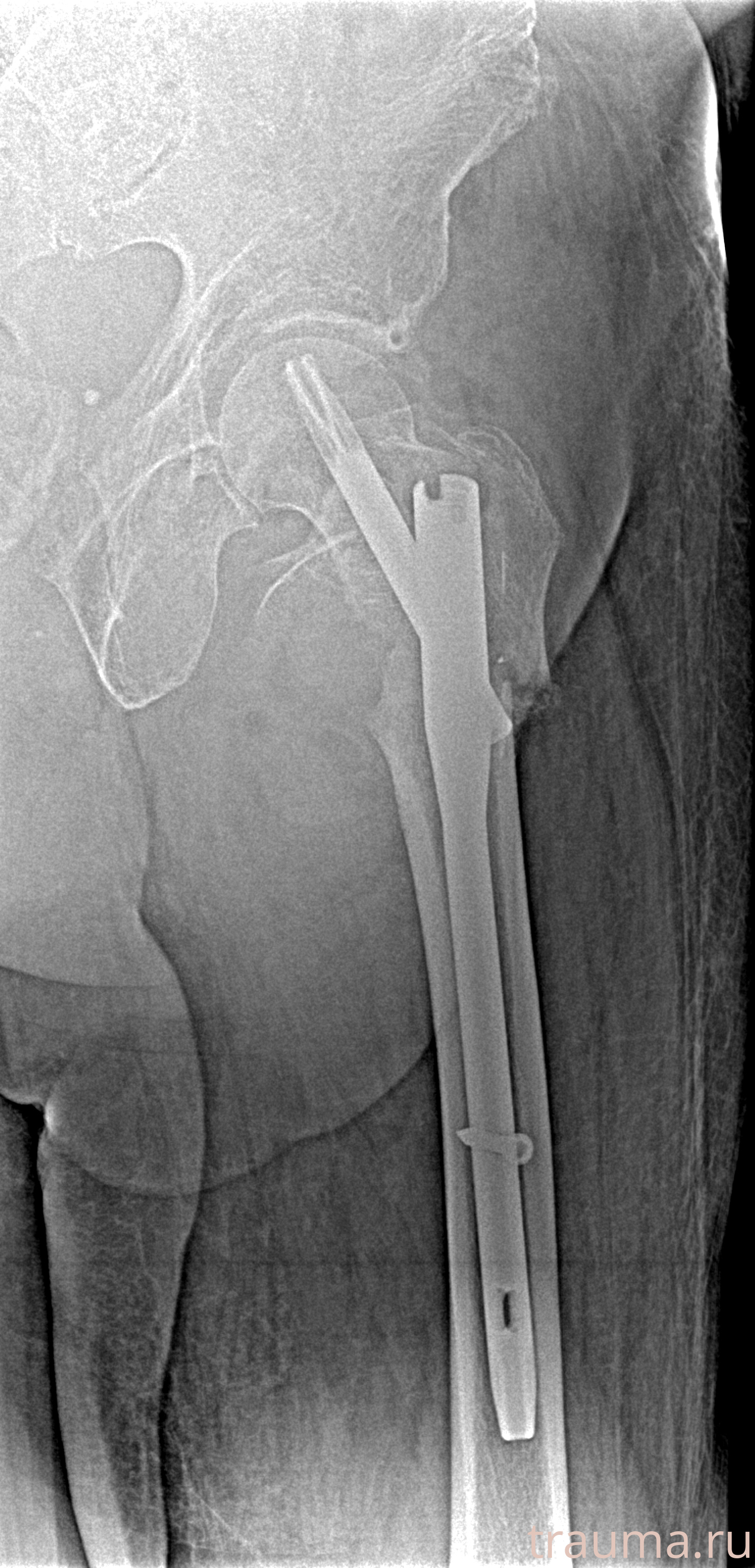 Рентген на дому: по вашему адресу приезжает врач-рентгенолог, травматолог-ортопед с мобильным рентгеновским аппаратом, проводит диагностику травмы или заболевания, делает необходимые рентгенограммы, дает рекомендации по дальнейшему лечению. Получить качественные снимки в домашних условиях возможно благодаря уникальной методике, разработанной МосРентген Центром для института  Склифосовского