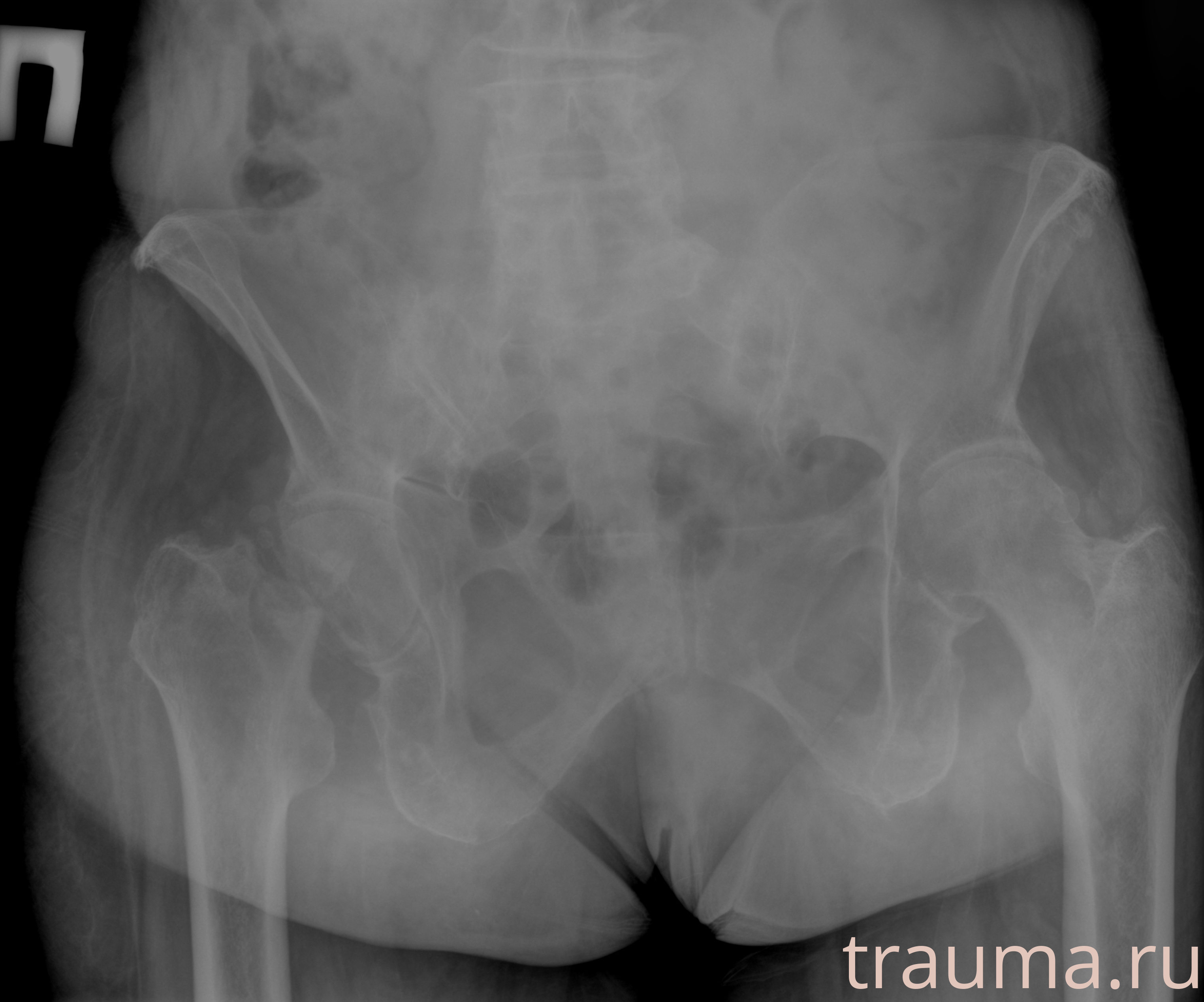 Рентген на дому: по вашему адресу приезжает врач-рентгенолог, травматолог-ортопед с мобильным рентгеновским аппаратом, проводит диагностику травмы или заболевания, делает необходимые рентгенограммы, дает рекомендации по дальнейшему лечению. Получить качественные снимки в домашних условиях возможно благодаря уникальной методике, разработанной МосРентген Центром для института  Склифосовского