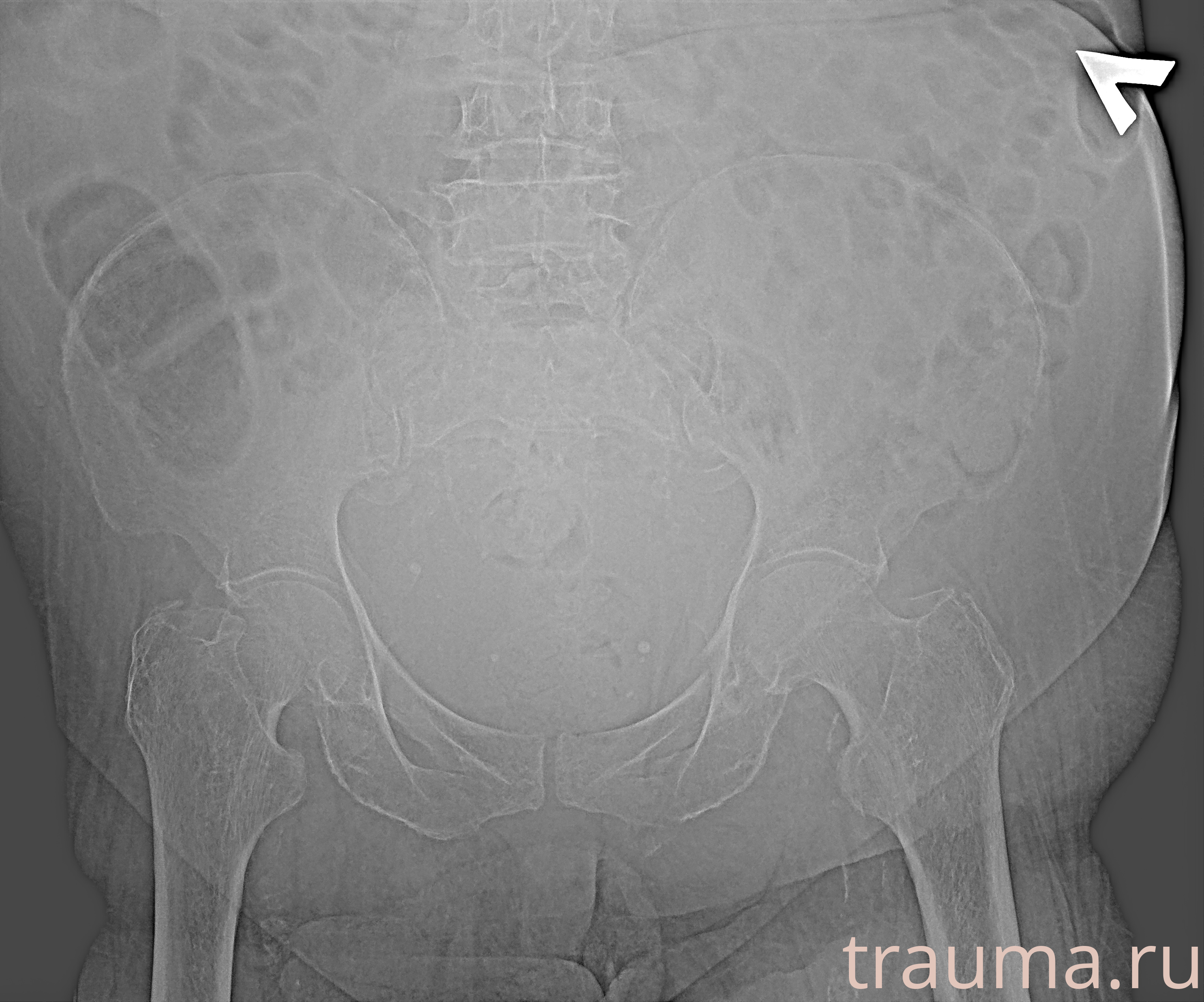 Рентген на дому: по вашему адресу приезжает врач-рентгенолог, травматолог-ортопед с мобильным рентгеновским аппаратом, проводит диагностику травмы или заболевания, делает необходимые рентгенограммы, дает рекомендации по дальнейшему лечению. Получить качественные снимки в домашних условиях возможно благодаря уникальной методике, разработанной МосРентген Центром для института  Склифосовского