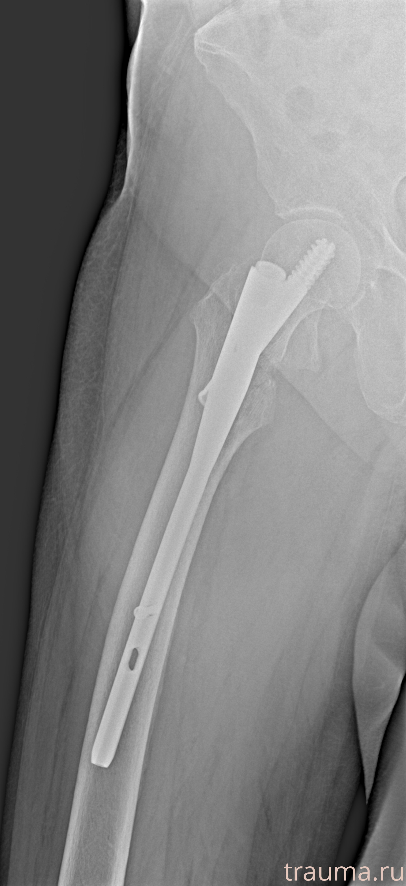 Рентген на дому: по вашему адресу приезжает врач-рентгенолог, травматолог-ортопед с мобильным рентгеновским аппаратом, проводит диагностику травмы или заболевания, делает необходимые рентгенограммы, дает рекомендации по дальнейшему лечению. Получить качественные снимки в домашних условиях возможно благодаря уникальной методике, разработанной МосРентген Центром для института  Склифосовского