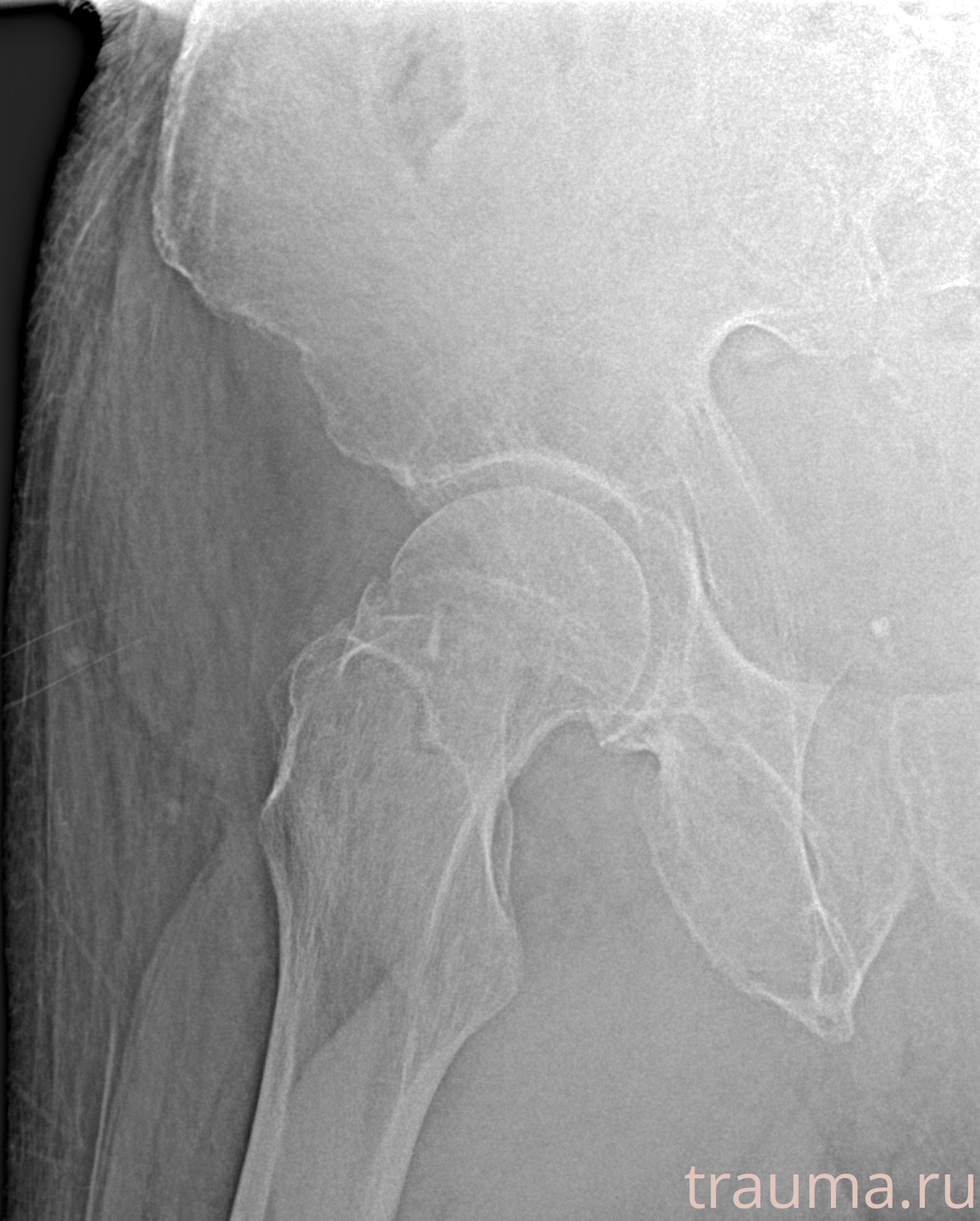 Рентген на дому: по вашему адресу приезжает врач-рентгенолог, травматолог-ортопед с мобильным рентгеновским аппаратом, проводит диагностику травмы или заболевания, делает необходимые рентгенограммы, дает рекомендации по дальнейшему лечению. Получить качественные снимки в домашних условиях возможно благодаря уникальной методике, разработанной МосРентген Центром для института  Склифосовского