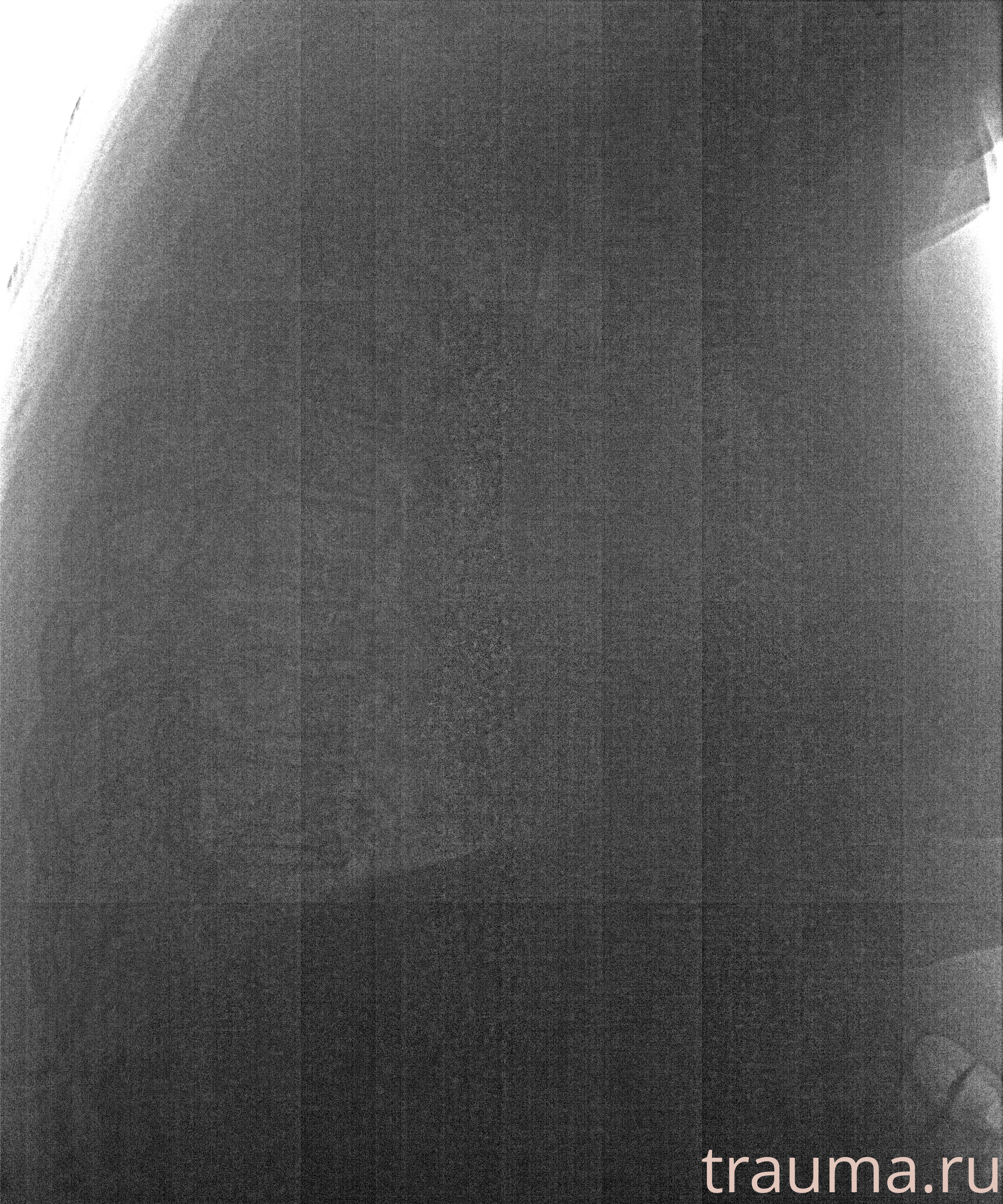 Рентген на дому: по вашему адресу приезжает врач-рентгенолог, травматолог-ортопед с мобильным рентгеновским аппаратом, проводит диагностику травмы или заболевания, делает необходимые рентгенограммы, дает рекомендации по дальнейшему лечению. Получить качественные снимки в домашних условиях возможно благодаря уникальной методике, разработанной МосРентген Центром для института  Склифосовского