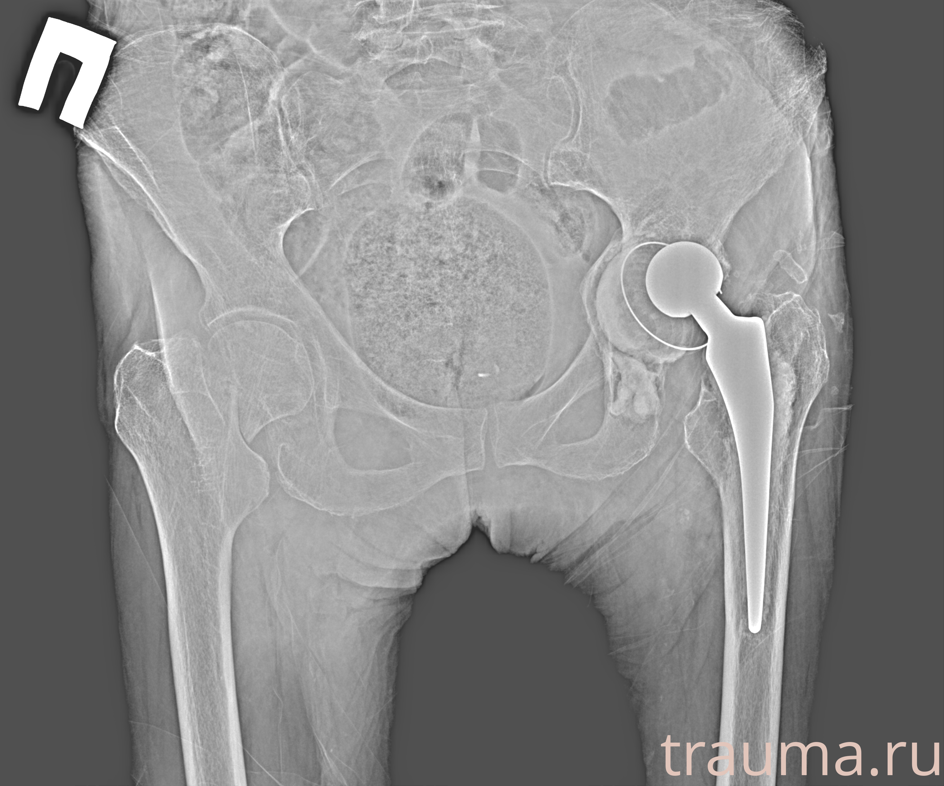 Рентген на дому: по вашему адресу приезжает врач-рентгенолог, травматолог-ортопед с мобильным рентгеновским аппаратом, проводит диагностику травмы или заболевания, делает необходимые рентгенограммы, дает рекомендации по дальнейшему лечению. Получить качественные снимки в домашних условиях возможно благодаря уникальной методике, разработанной МосРентген Центром для института  Склифосовского