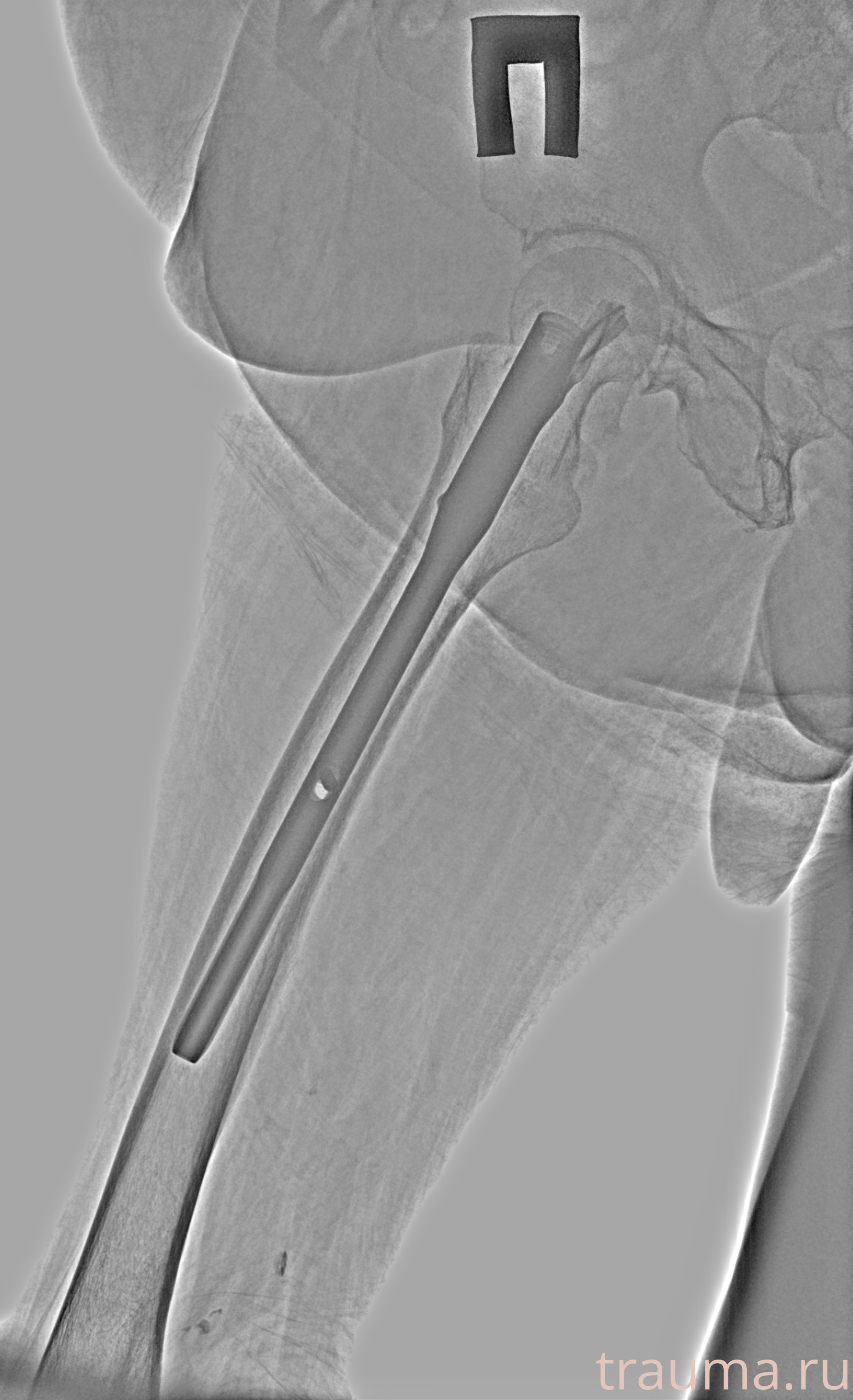 Рентген на дому: по вашему адресу приезжает врач-рентгенолог, травматолог-ортопед с мобильным рентгеновским аппаратом, проводит диагностику травмы или заболевания, делает необходимые рентгенограммы, дает рекомендации по дальнейшему лечению. Получить качественные снимки в домашних условиях возможно благодаря уникальной методике, разработанной МосРентген Центром для института  Склифосовского