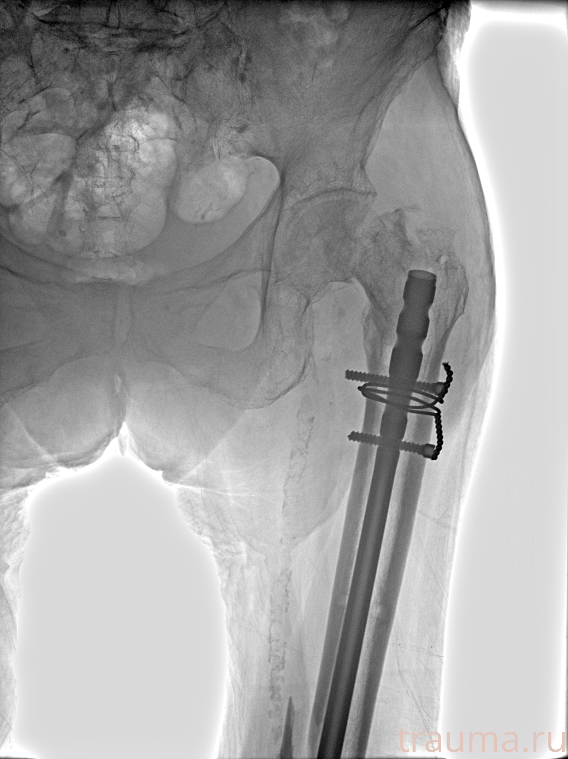 Рентген на дому: по вашему адресу приезжает врач-рентгенолог, травматолог-ортопед с мобильным рентгеновским аппаратом, проводит диагностику травмы или заболевания, делает необходимые рентгенограммы, дает рекомендации по дальнейшему лечению. Получить качественные снимки в домашних условиях возможно благодаря уникальной методике, разработанной МосРентген Центром для института  Склифосовского
