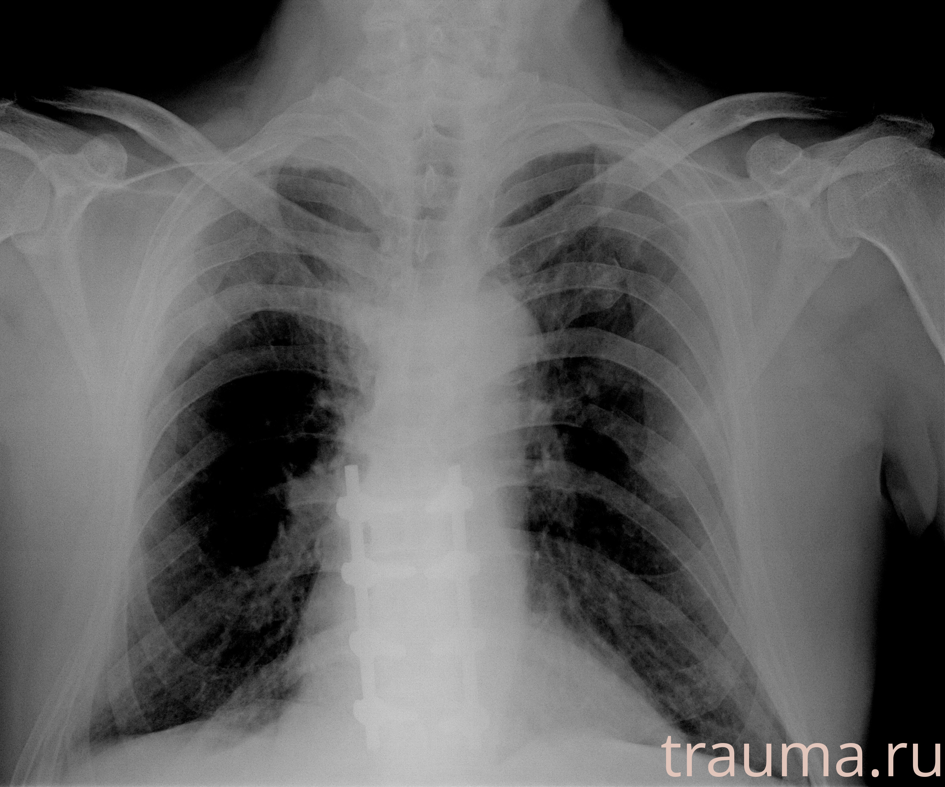 Рентген на дому: по вашему адресу приезжает врач-рентгенолог, травматолог-ортопед с мобильным рентгеновским аппаратом, проводит диагностику травмы или заболевания, делает необходимые рентгенограммы, дает рекомендации по дальнейшему лечению. Получить качественные снимки в домашних условиях возможно благодаря уникальной методике, разработанной МосРентген Центром для института  Склифосовского