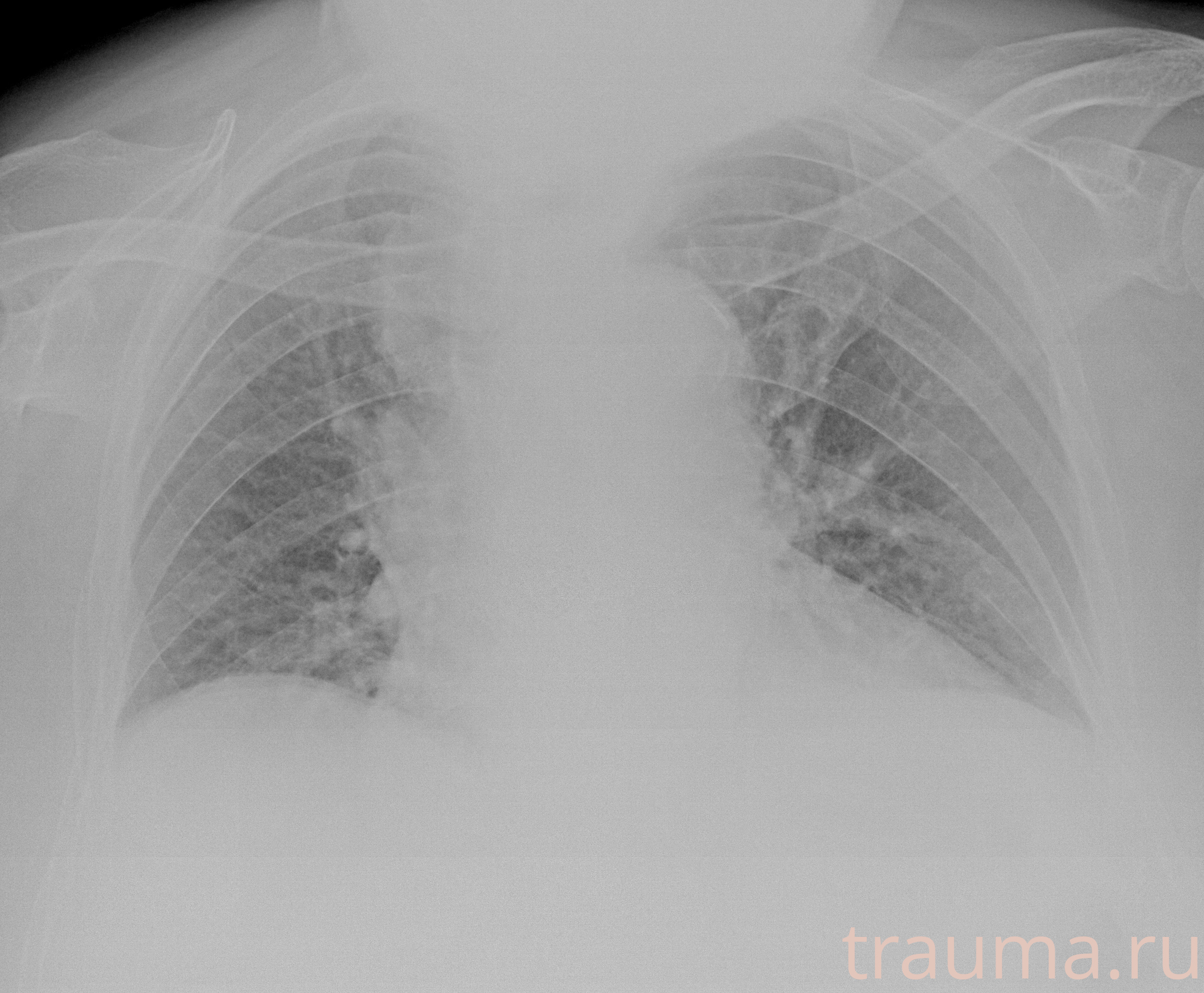 Рентген на дому: по вашему адресу приезжает врач-рентгенолог, травматолог-ортопед с мобильным рентгеновским аппаратом, проводит диагностику травмы или заболевания, делает необходимые рентгенограммы, дает рекомендации по дальнейшему лечению. Получить качественные снимки в домашних условиях возможно благодаря уникальной методике, разработанной МосРентген Центром для института  Склифосовского