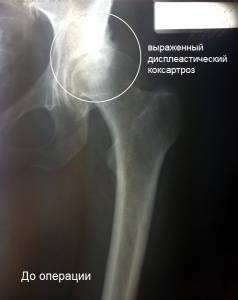 диспластический коксартроз, тотальное эндопротезирование тазобедренного сустава диспластический коксартроз, тотальное эндопротезирование тазобедренного сустава
