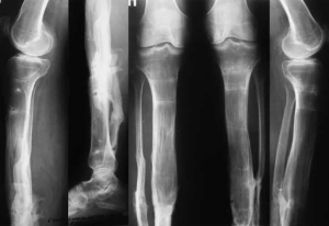 Влияние полиморфизма генов IL-17A и PPARG на течение гнойных осложнений после лечения пострадавших с травмами костей нижних конечностей