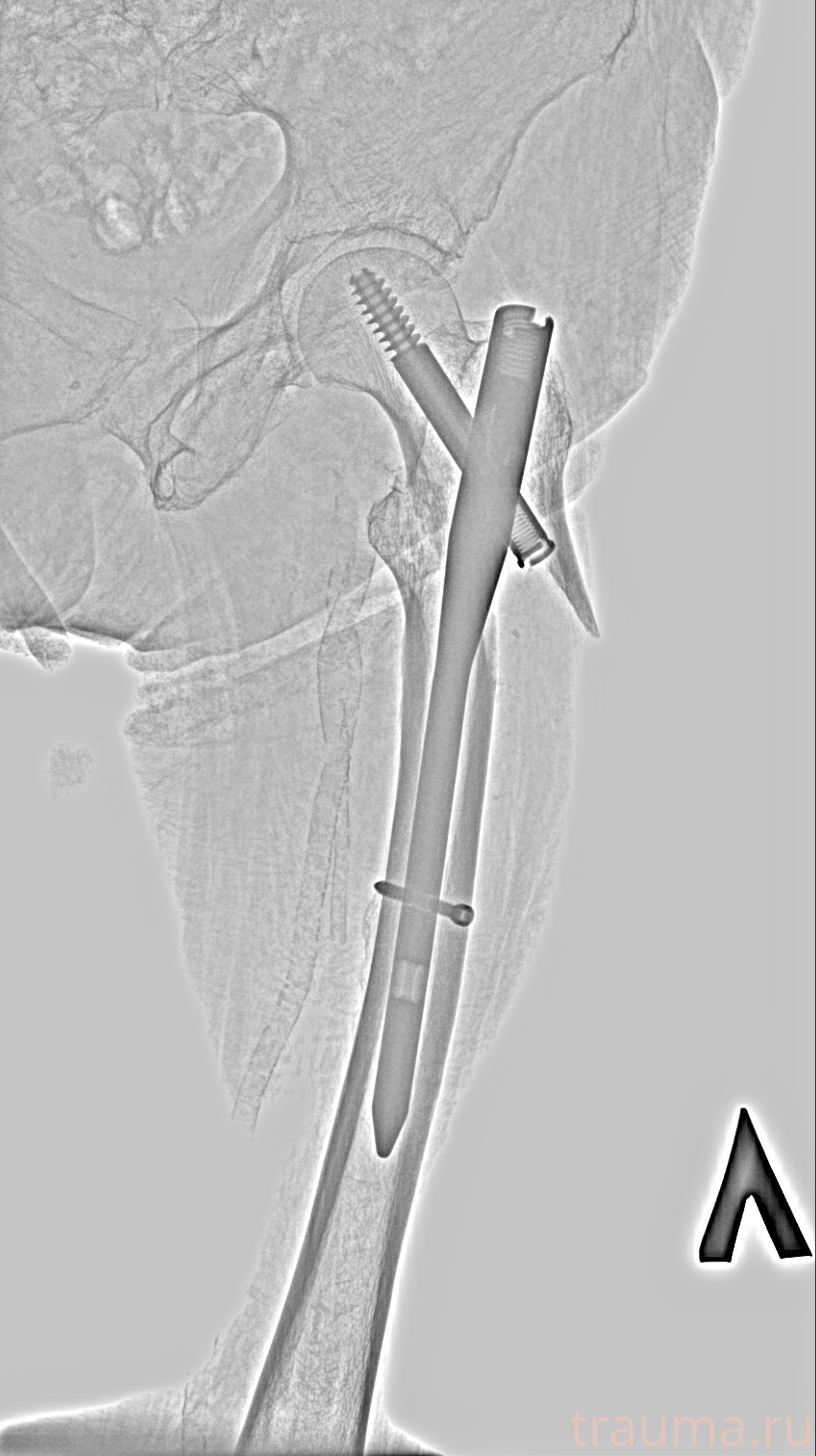 Рентген на дому: по вашему адресу приезжает врач-рентгенолог, травматолог-ортопед с мобильным рентгеновским аппаратом, проводит диагностику травмы или заболевания, делает необходимые рентгенограммы, дает рекомендации по дальнейшему лечению. Получить качественные снимки в домашних условиях возможно благодаря уникальной методике, разработанной МосРентген Центром для института  Склифосовского