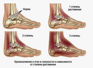 Лечение отечно-болевого синдрома при сочетанной  