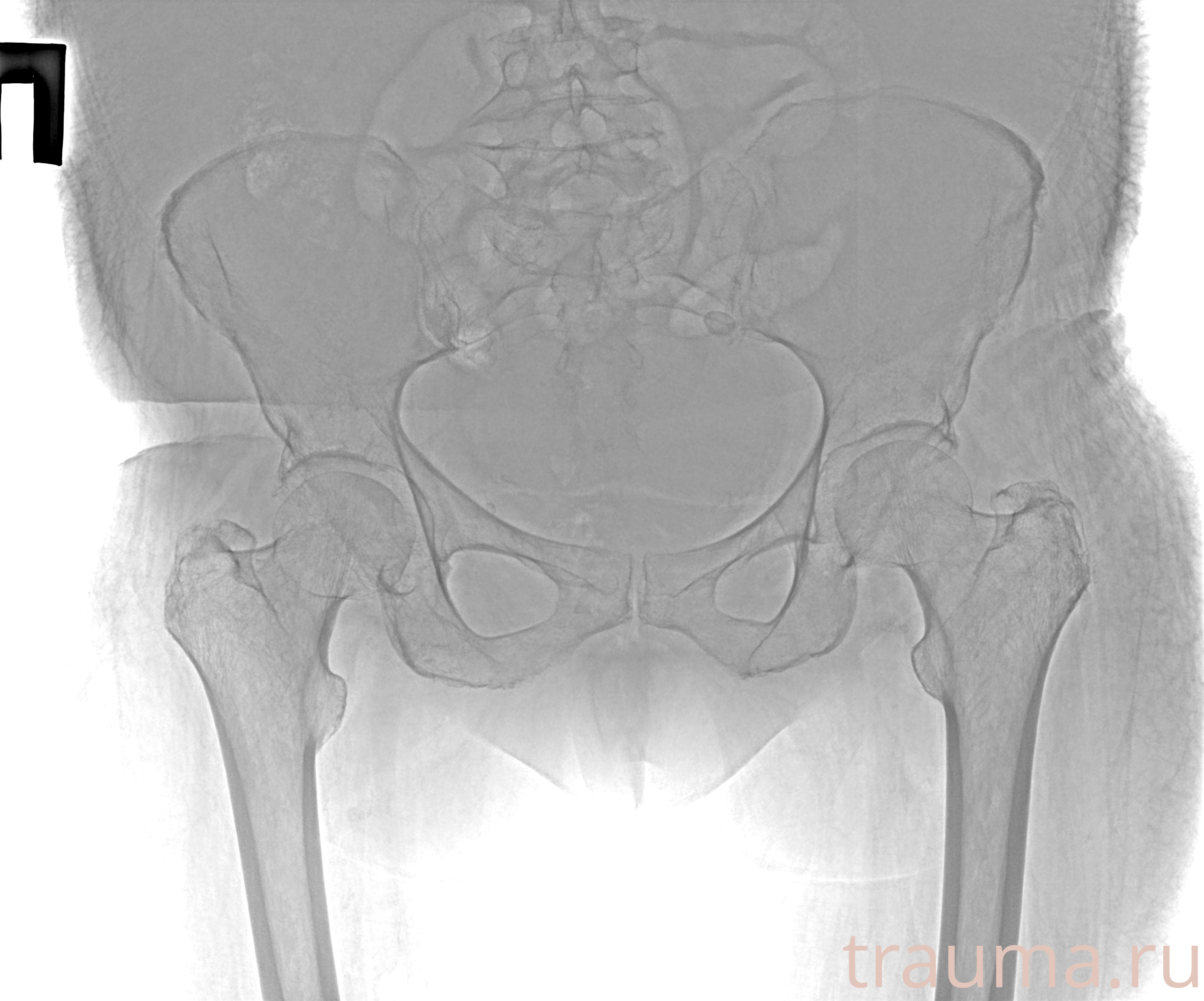 Рентген на дому: по вашему адресу приезжает врач-рентгенолог, травматолог-ортопед с мобильным рентгеновским аппаратом, проводит диагностику травмы или заболевания, делает необходимые рентгенограммы, дает рекомендации по дальнейшему лечению. Получить качественные снимки в домашних условиях возможно благодаря уникальной методике, разработанной МосРентген Центром для института  Склифосовского
