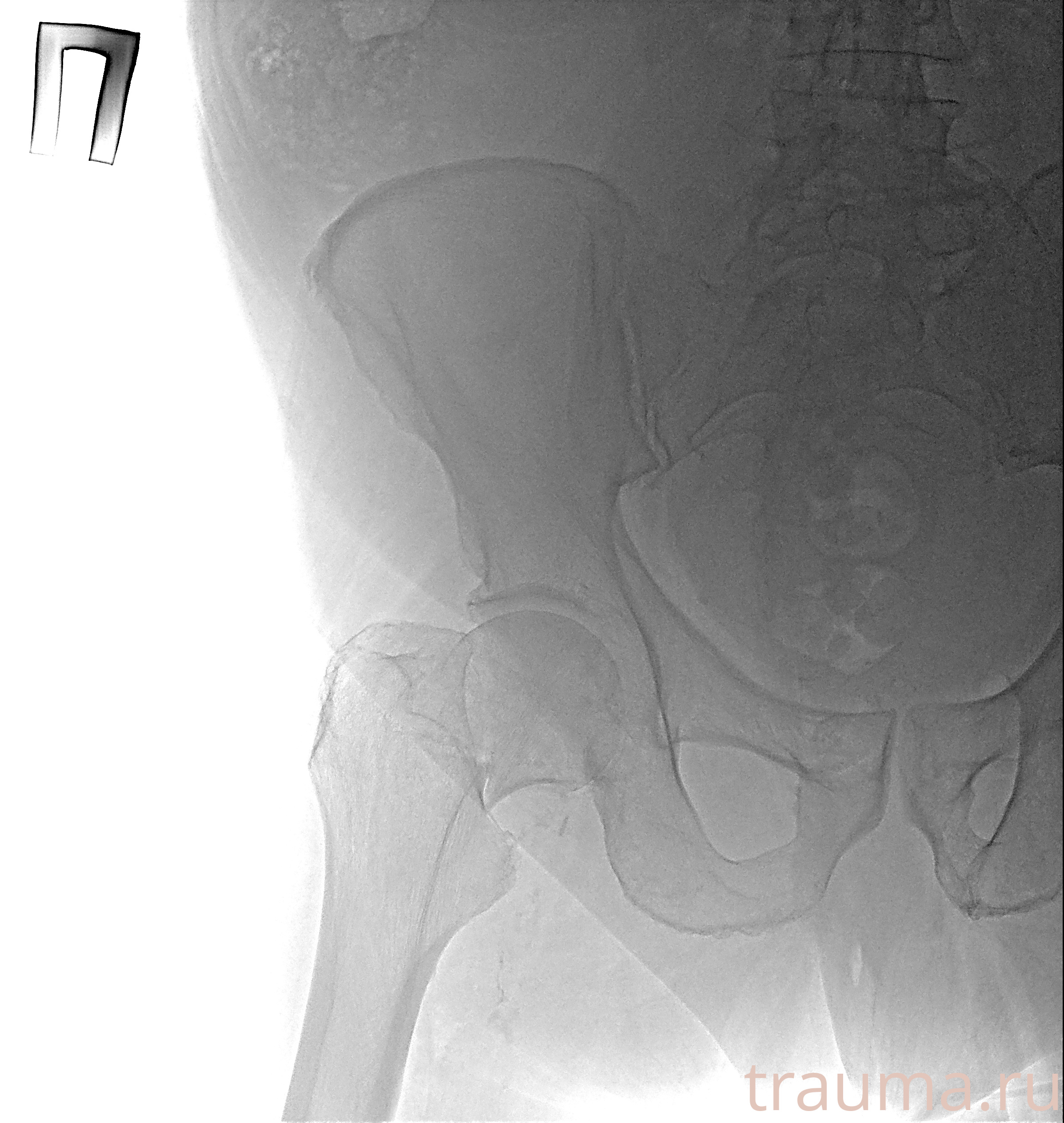 Рентген на дому: по вашему адресу приезжает врач-рентгенолог, травматолог-ортопед с мобильным рентгеновским аппаратом, проводит диагностику травмы или заболевания, делает необходимые рентгенограммы, дает рекомендации по дальнейшему лечению. Получить качественные снимки в домашних условиях возможно благодаря уникальной методике, разработанной МосРентген Центром для института  Склифосовского