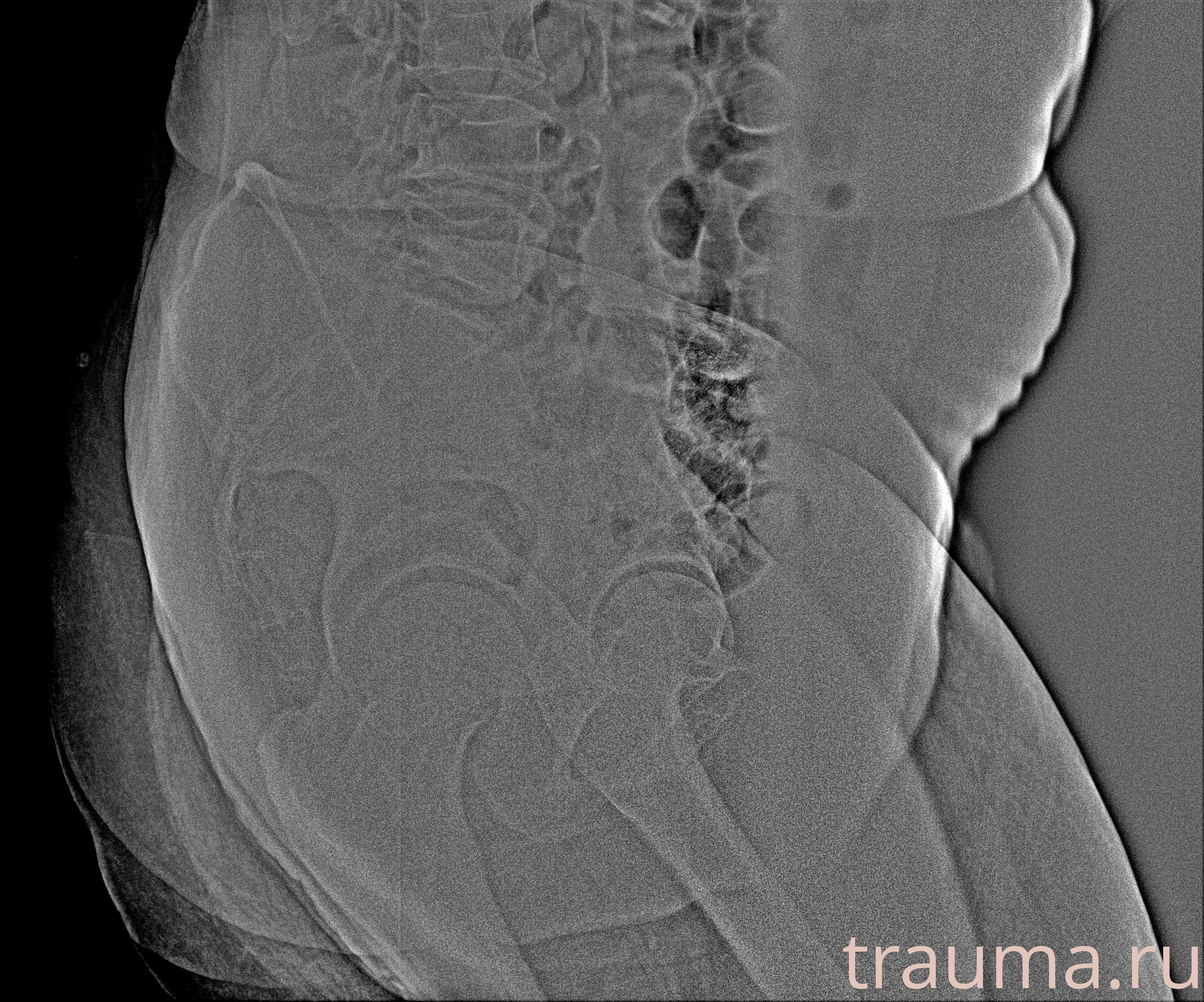 Рентген на дому: по вашему адресу приезжает врач-рентгенолог, травматолог-ортопед с мобильным рентгеновским аппаратом, проводит диагностику травмы или заболевания, делает необходимые рентгенограммы, дает рекомендации по дальнейшему лечению. Получить качественные снимки в домашних условиях возможно благодаря уникальной методике, разработанной МосРентген Центром для института  Склифосовского