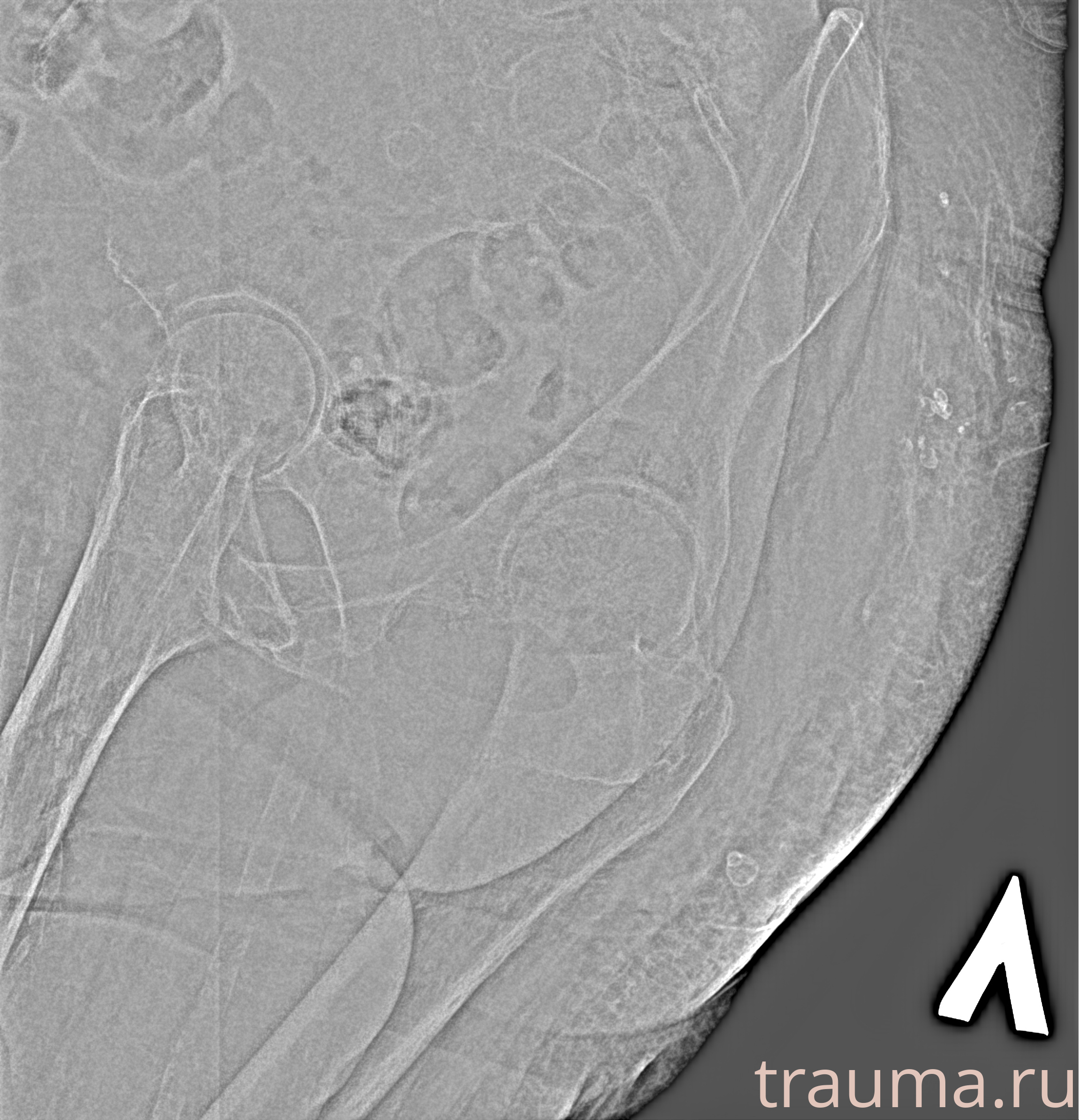 Рентген на дому: по вашему адресу приезжает врач-рентгенолог, травматолог-ортопед с мобильным рентгеновским аппаратом, проводит диагностику травмы или заболевания, делает необходимые рентгенограммы, дает рекомендации по дальнейшему лечению. Получить качественные снимки в домашних условиях возможно благодаря уникальной методике, разработанной МосРентген Центром для института  Склифосовского