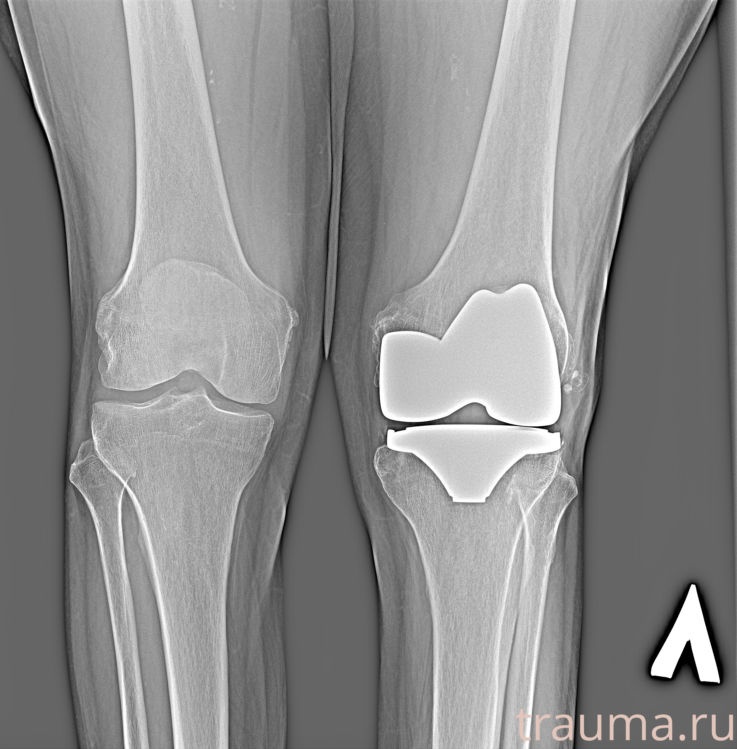 Рентген на дому: по вашему адресу приезжает врач-рентгенолог, травматолог-ортопед с мобильным рентгеновским аппаратом, проводит диагностику травмы или заболевания, делает необходимые рентгенограммы, дает рекомендации по дальнейшему лечению. Получить качественные снимки в домашних условиях возможно благодаря уникальной методике, разработанной МосРентген Центром для института  Склифосовского