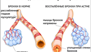 Рентгеноанатомические основы исследования легких. Учение о бронхах. Глава 12 Рентгеноанатомические основы исследования легких. Учение о бронхах. Глава 12