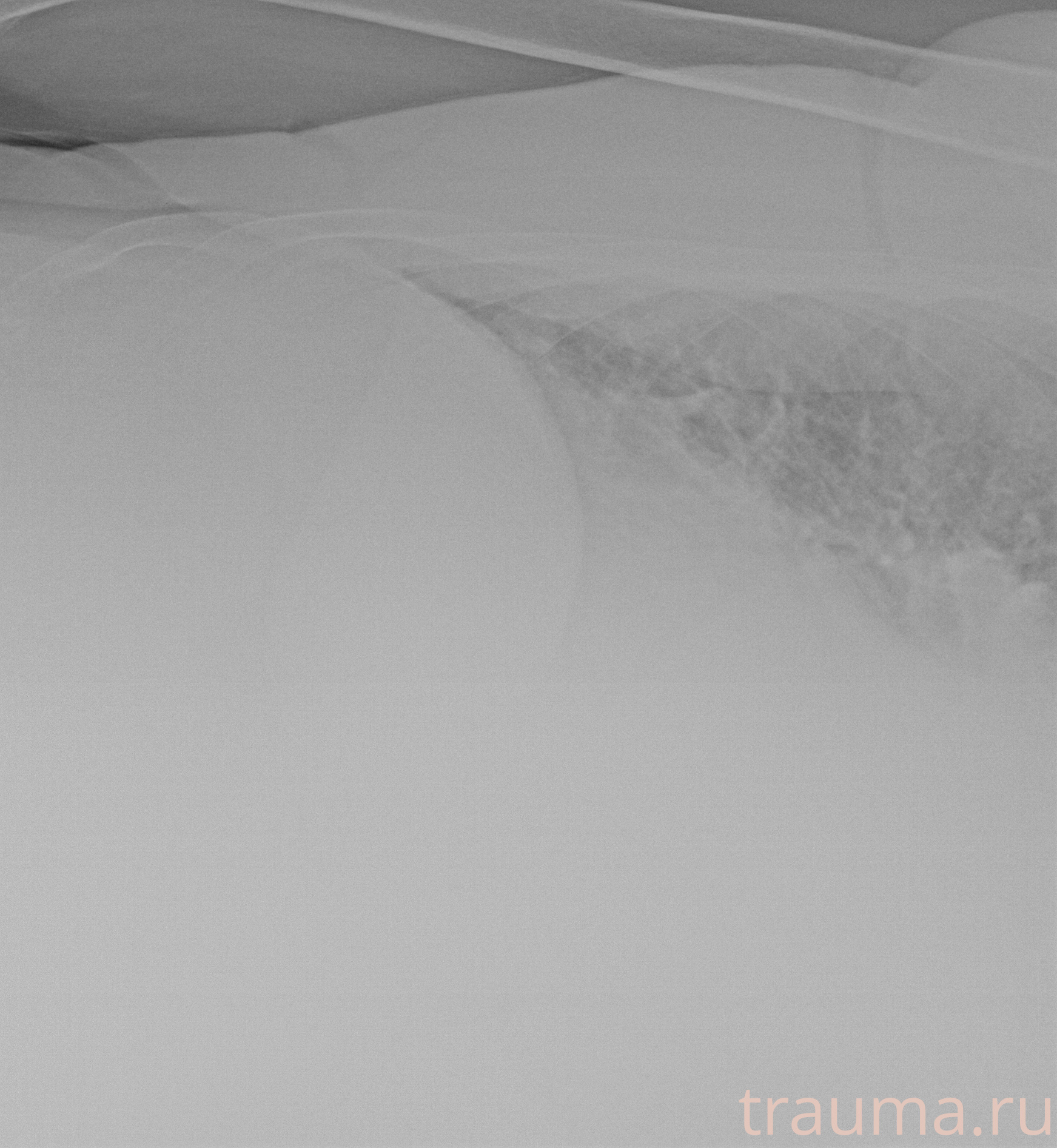 Рентген на дому: по вашему адресу приезжает врач-рентгенолог, травматолог-ортопед с мобильным рентгеновским аппаратом, проводит диагностику травмы или заболевания, делает необходимые рентгенограммы, дает рекомендации по дальнейшему лечению. Получить качественные снимки в домашних условиях возможно благодаря уникальной методике, разработанной МосРентген Центром для института  Склифосовского