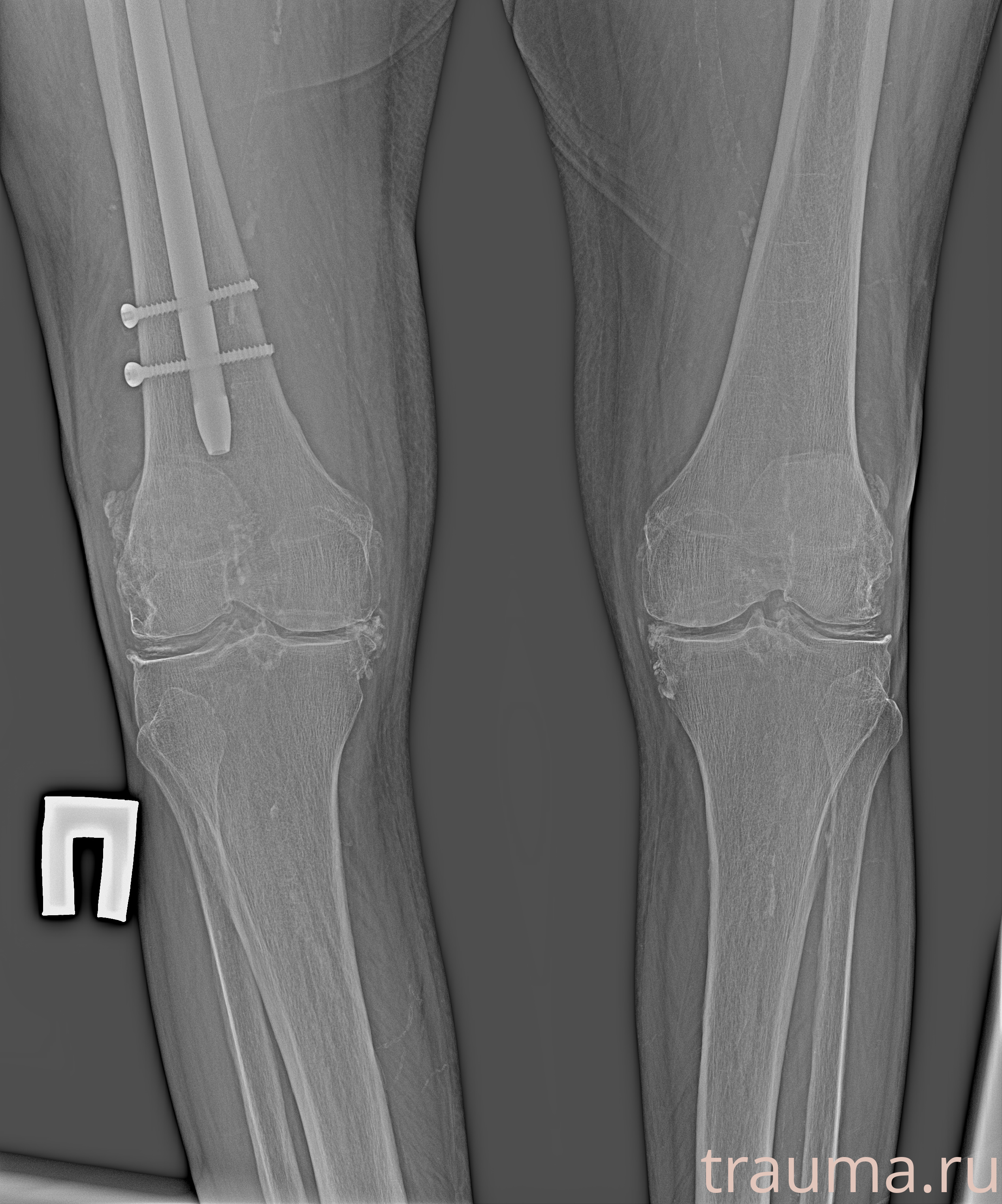Рентген на дому: по вашему адресу приезжает врач-рентгенолог, травматолог-ортопед с мобильным рентгеновским аппаратом, проводит диагностику травмы или заболевания, делает необходимые рентгенограммы, дает рекомендации по дальнейшему лечению. Получить качественные снимки в домашних условиях возможно благодаря уникальной методике, разработанной МосРентген Центром для института  Склифосовского