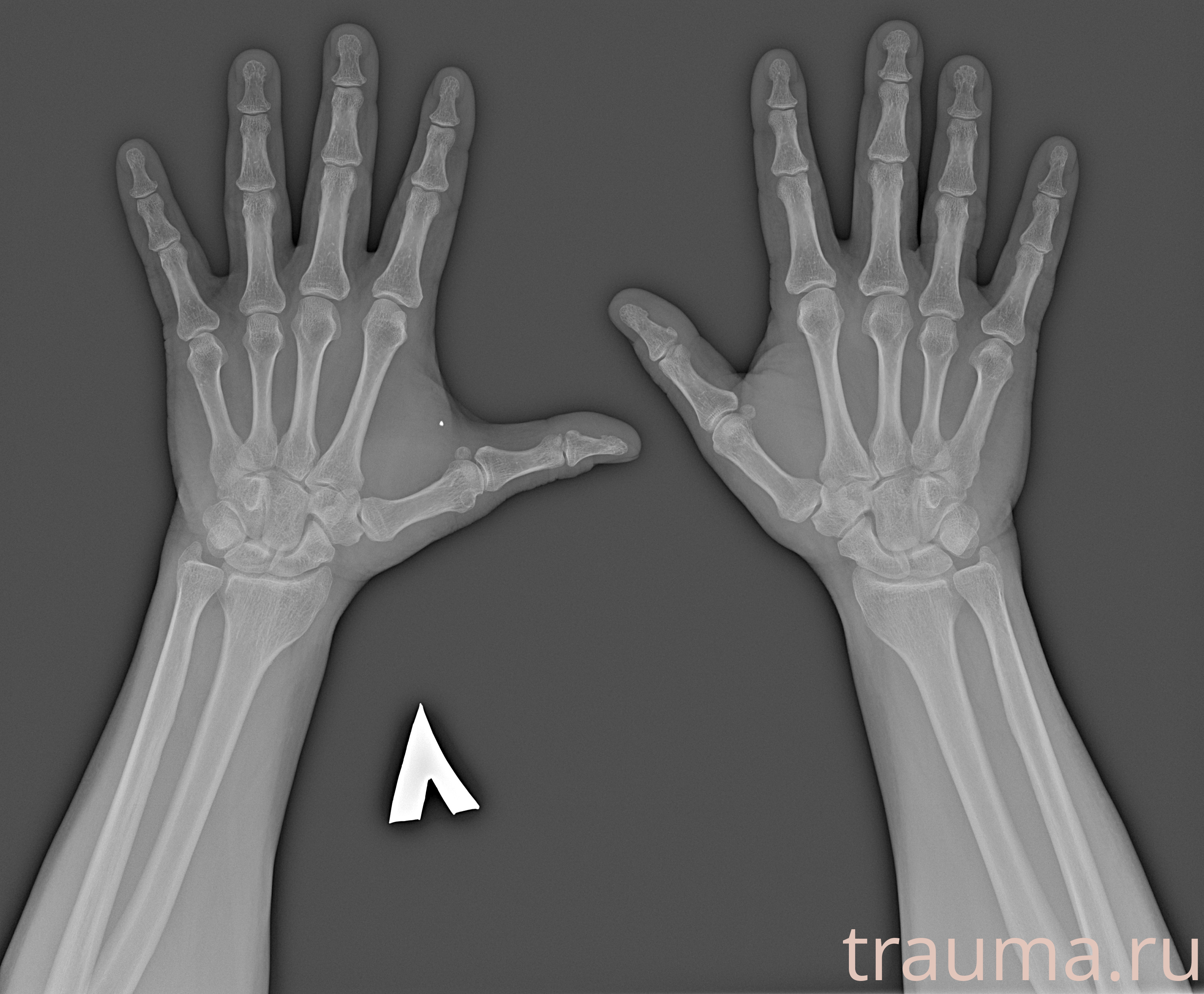 Рентген на дому: по вашему адресу приезжает врач-рентгенолог, травматолог-ортопед с мобильным рентгеновским аппаратом, проводит диагностику травмы или заболевания, делает необходимые рентгенограммы, дает рекомендации по дальнейшему лечению. Получить качественные снимки в домашних условиях возможно благодаря уникальной методике, разработанной МосРентген Центром для института  Склифосовского