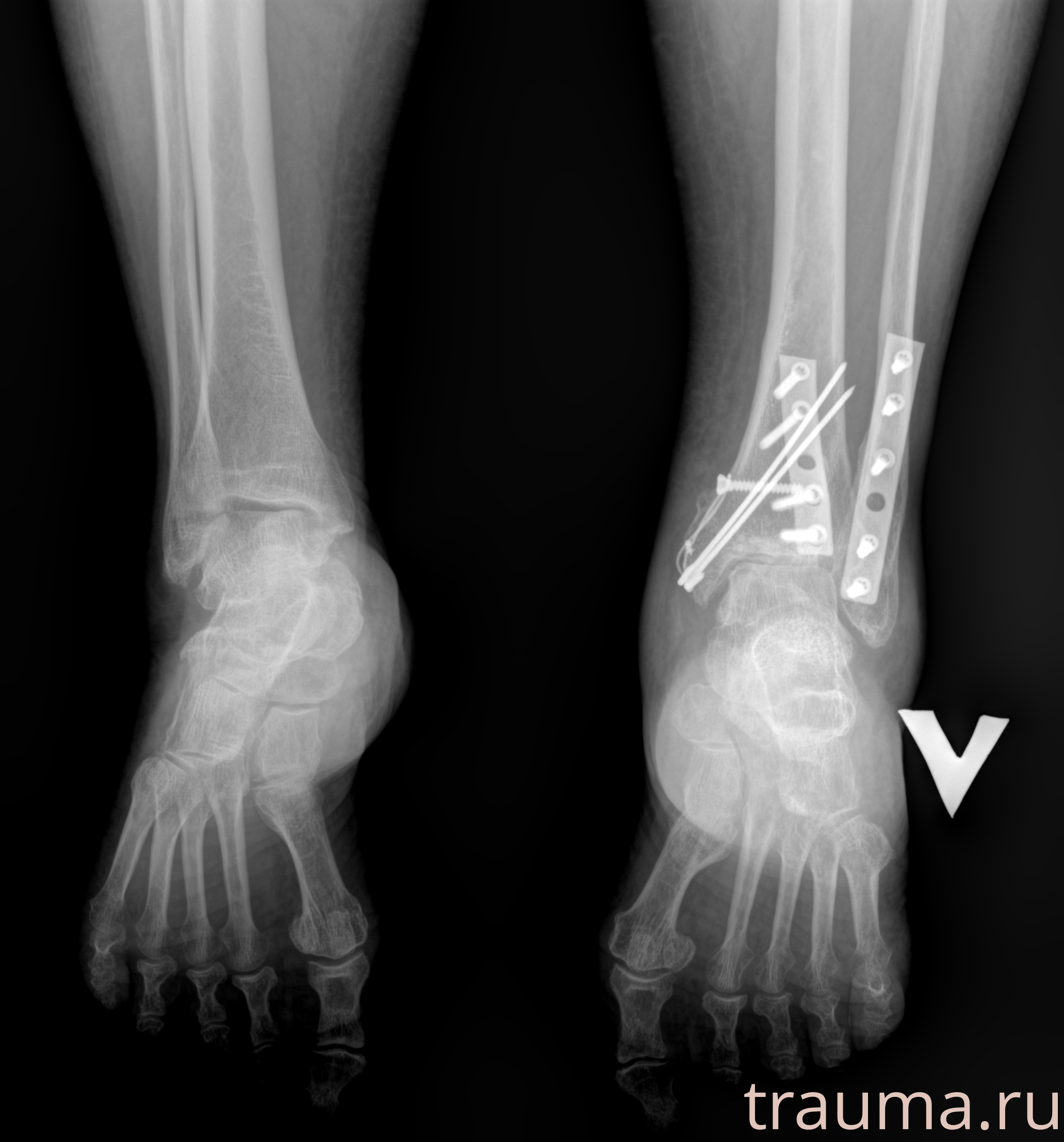 Рентген на дому: по вашему адресу приезжает врач-рентгенолог, травматолог-ортопед с мобильным рентгеновским аппаратом, проводит диагностику травмы или заболевания, делает необходимые рентгенограммы, дает рекомендации по дальнейшему лечению. Получить качественные снимки в домашних условиях возможно благодаря уникальной методике, разработанной МосРентген Центром для института  Склифосовского