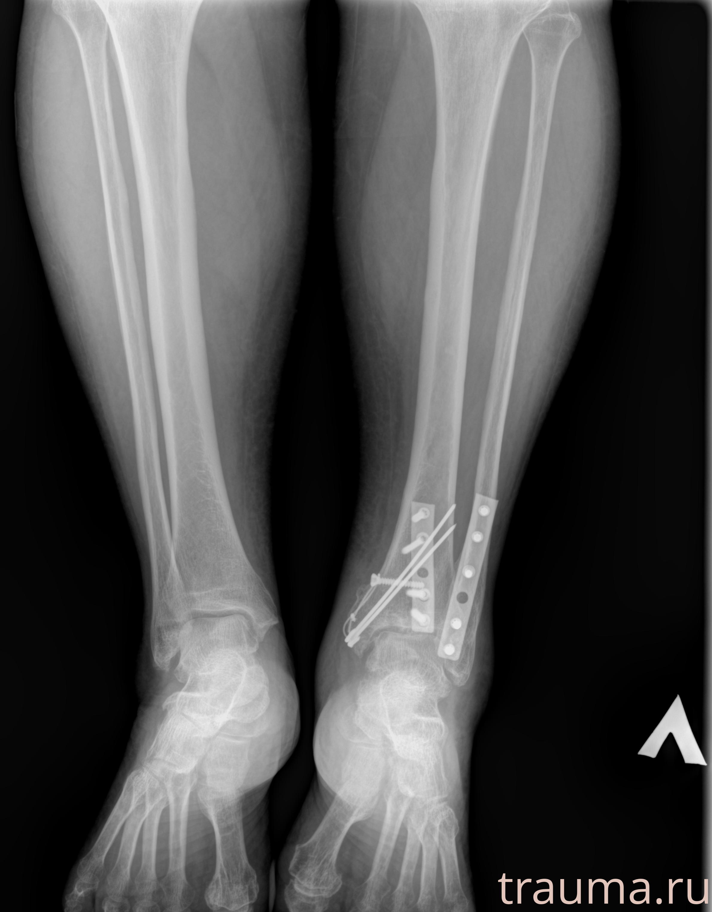 Рентген на дому: по вашему адресу приезжает врач-рентгенолог, травматолог-ортопед с мобильным рентгеновским аппаратом, проводит диагностику травмы или заболевания, делает необходимые рентгенограммы, дает рекомендации по дальнейшему лечению. Получить качественные снимки в домашних условиях возможно благодаря уникальной методике, разработанной МосРентген Центром для института  Склифосовского